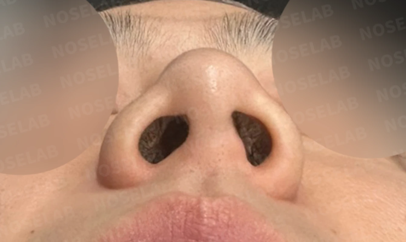 콧구멍 비대칭과 들린 코가 함께 생기는 이유, 늑연골 재건은 어떻게 하나 — 수술 전 / 수술 직후 0일 직후 사진은 부기가 있는 상태로 최종 결과와 다를 수 있습니다.