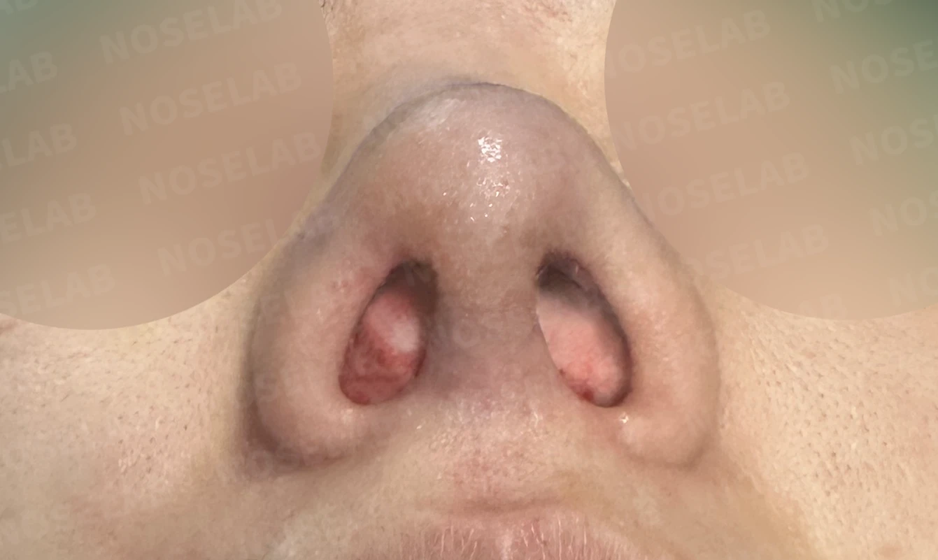 이전 수술 뒤 코가 딱딱해지고 짧아지는 구축, 왜 생기고 어떻게 재건하나 — 수술 전 / 수술 직후 0일 직후 사진은 부기가 있는 상태로 최종 결과와 다를 수 있습니다.