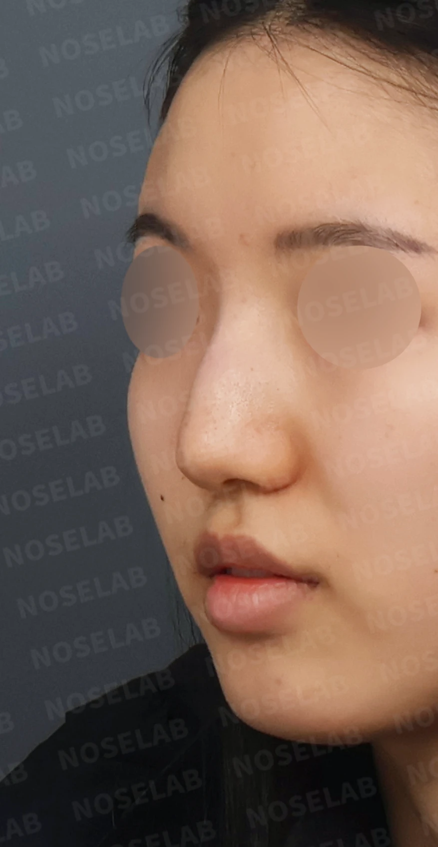 매부리코와 긴코 교정, 자가늑연골로 오똑한 코끝과 코막힘까지 해결 — 디자인 상담 정면, 좌측 측면, 비스듬한 측면 사진입니다.