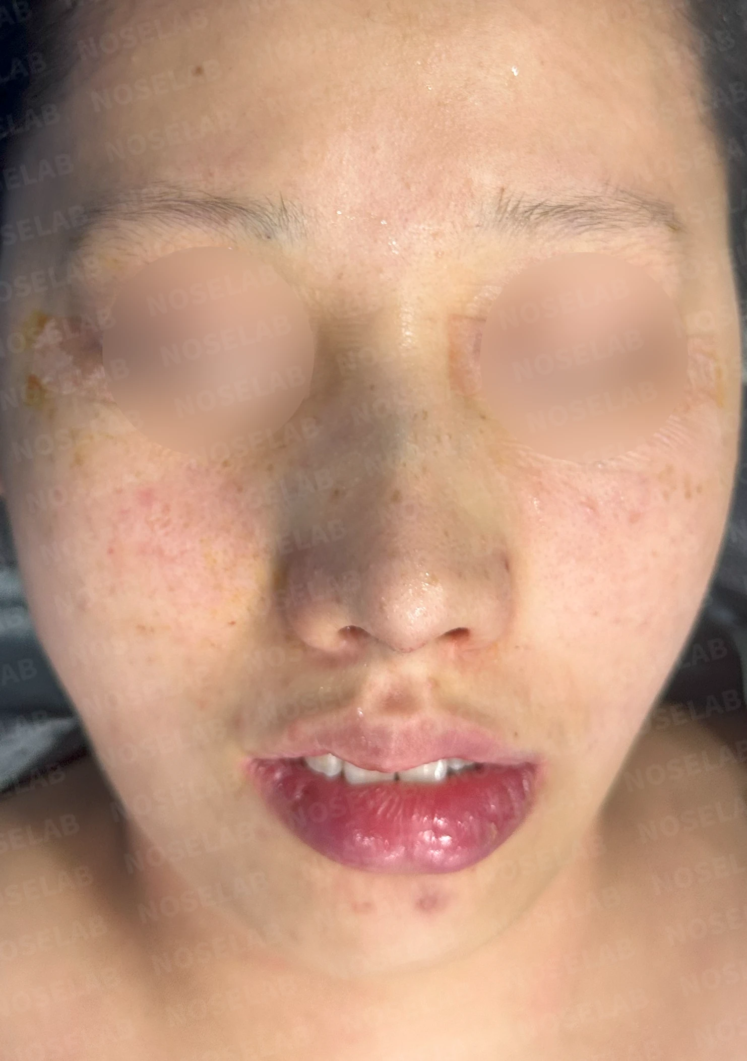 매부리코와 처진 코끝이 함께 있을 때, 콧대와 코끝의 균형 잡는 법 — 수술 전 / 수술 직후 0일 직후 사진은 부기가 있는 상태로 최종 결과와 다를 수 있습니다.
