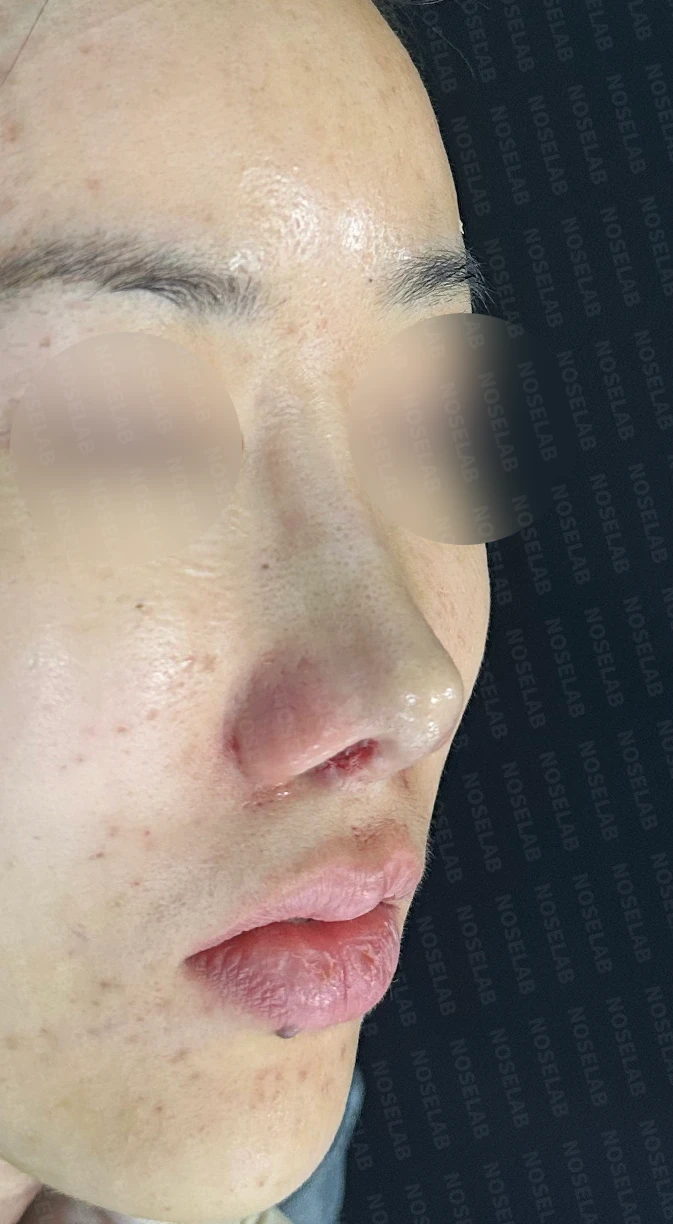 휜코, 뭉툭하고 처진코 수술 사례_대표원장 강차영 — 수술직후 사진 정면, 측면, 비스듬한 측면