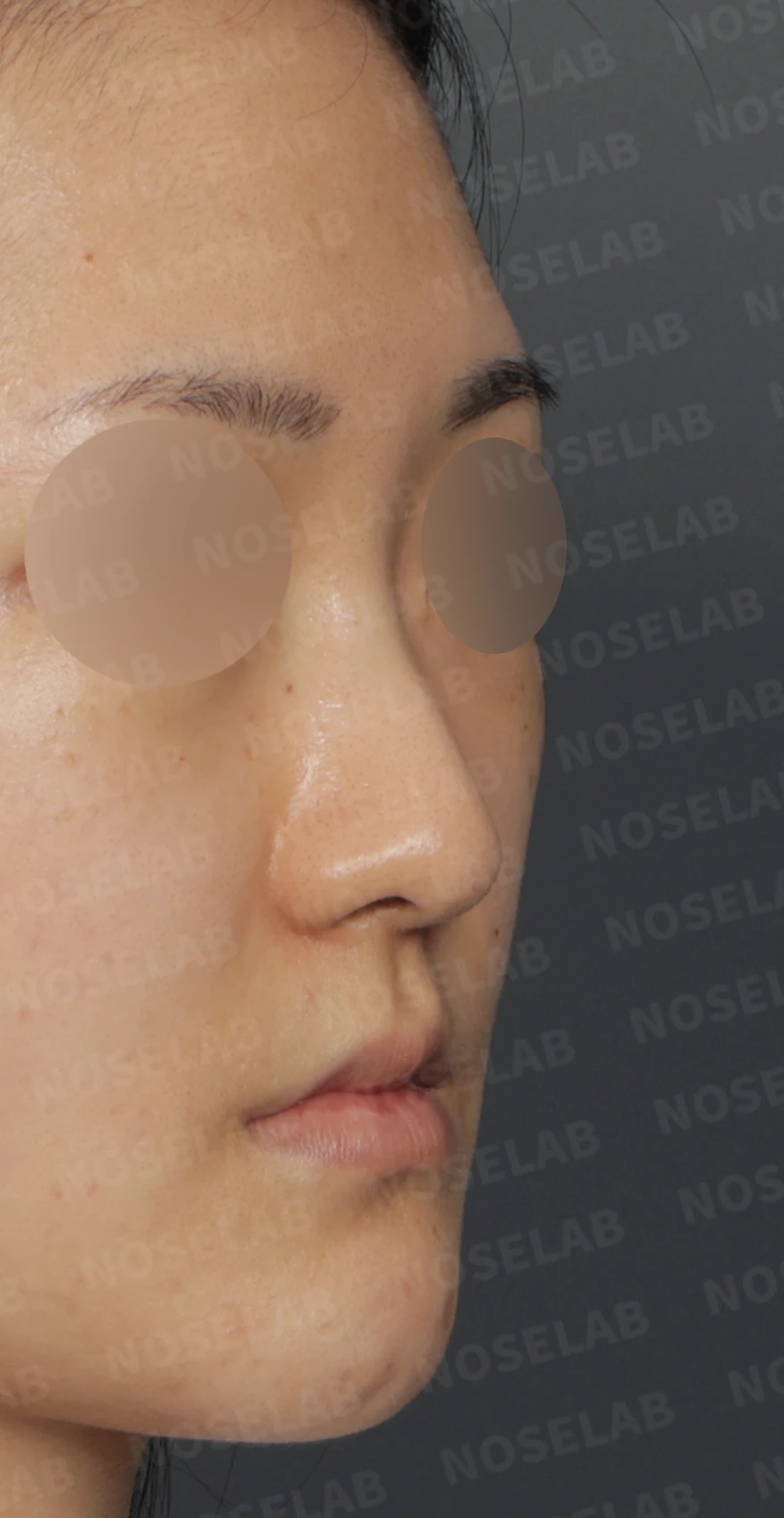 안면 비대칭과 휜코, 자가늑연골 비중격 재건으로 자연스럽게 교정한 코성형 — 디자인 상담 우측 측면, 비스듬한 측면, 비공 사진입니다.