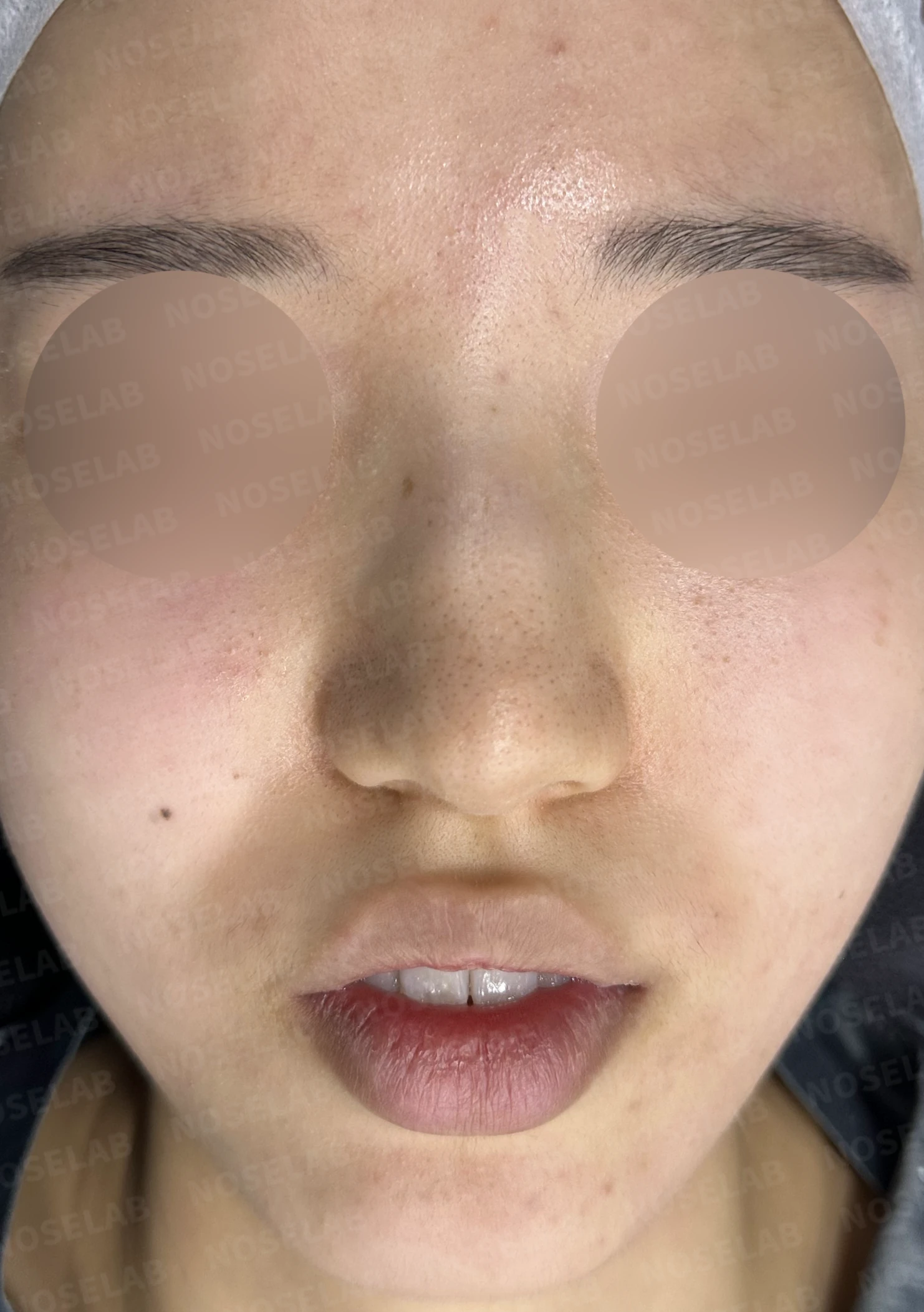 매부리코와 긴코 교정, 자가늑연골로 오똑한 코끝과 코막힘까지 해결 — 전(좌) 직후(후)
