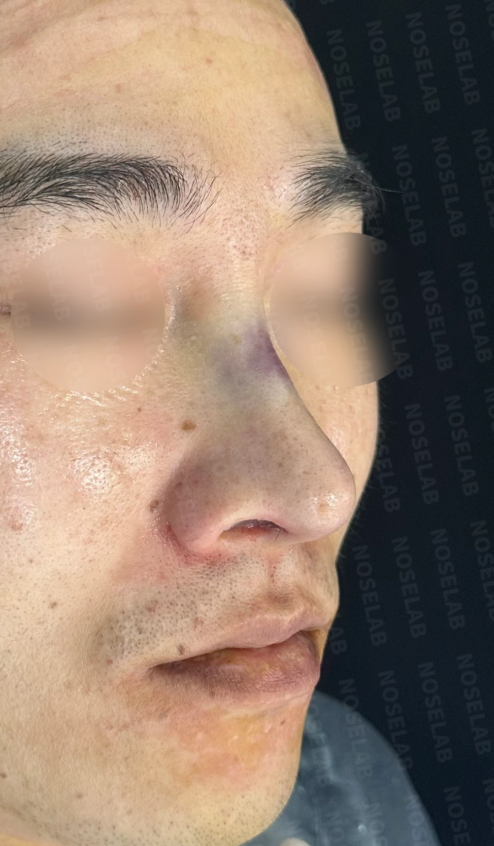 화살코, 휜코 교정 방법 — 수술 직후 0일 사진 90도, 45도, 정면 사진입니다. 직후 사진은 부기가 있는 상태로 최종 결과와 다를 수 있습니다.