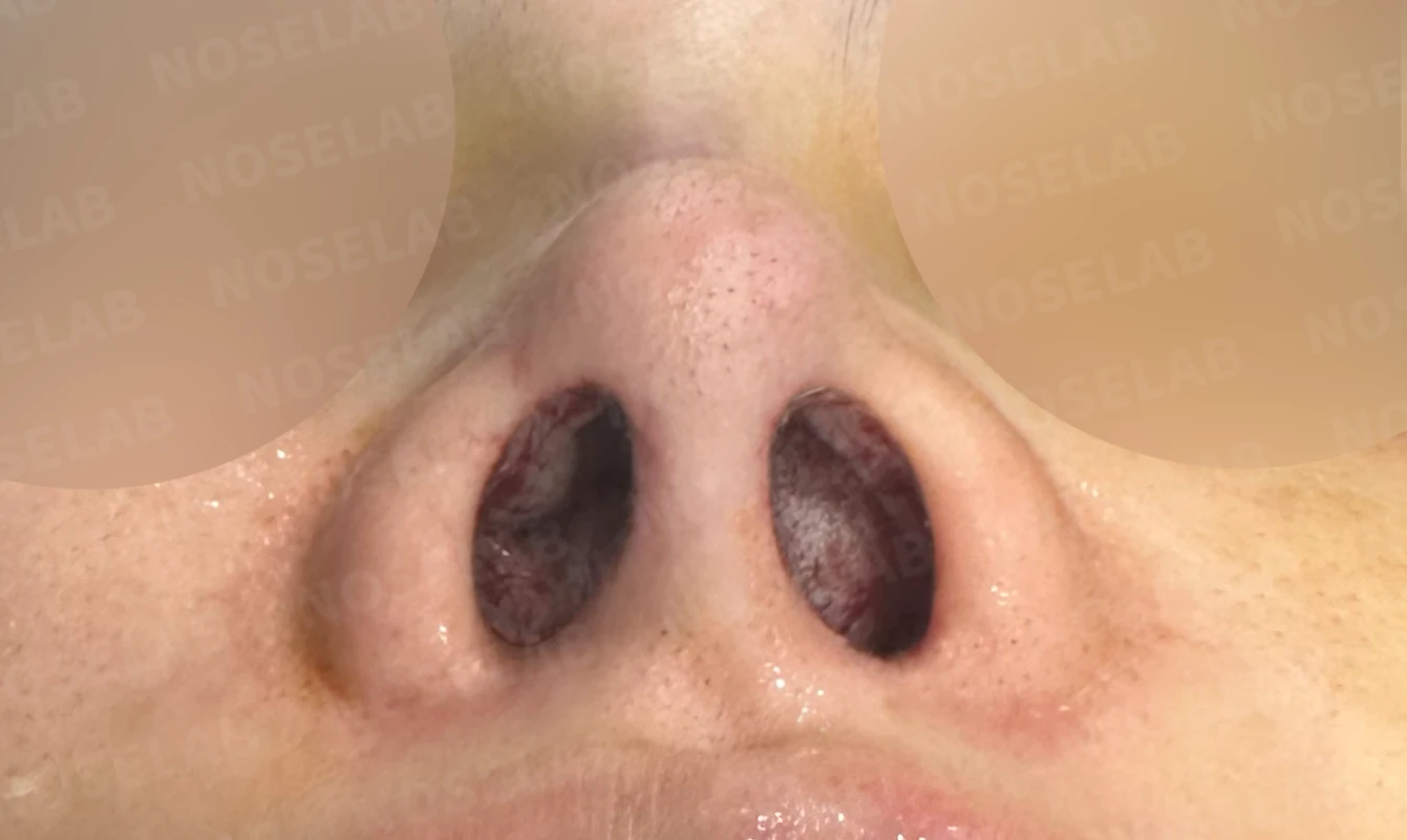 외상으로 코뼈가 부러지면 코가 어떻게 변형되고, 정복과 재건은 어떻게 하나 — 수술 전 / 수술 직후 0일 직후 사진은 부기가 있는 상태로 최종 결과와 다를 수 있습니다.