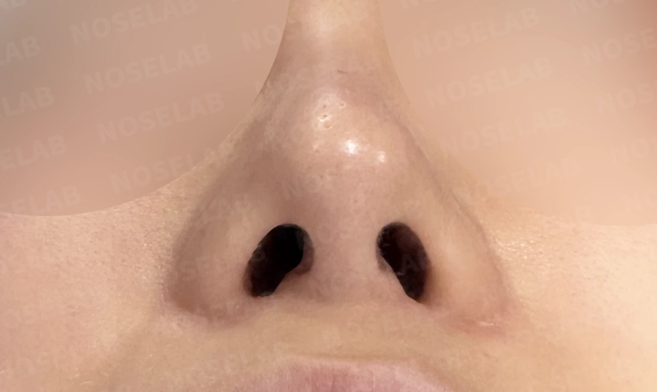 비중격 천공이 생기면 무엇이 문제이고 어떻게 재건하나 — 수술 전 / 수술 직후 0일 직후 사진은 부기가 있는 상태로 최종 결과와 다를 수 있습니다.