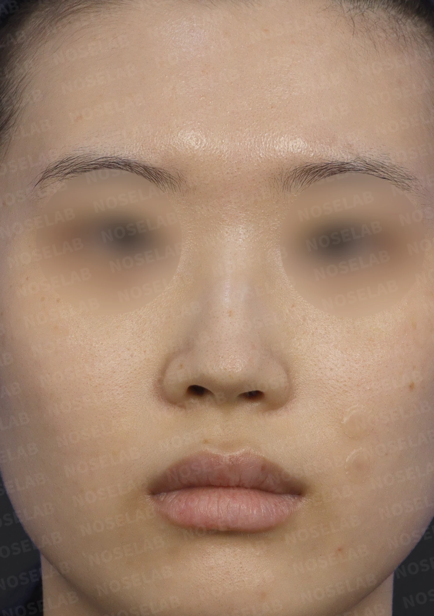 매부리코에 코의 휨과 비공 비대칭이 함께 오는 이유, 비중격 연골 교정은 어떻게 하나 — 수술 전 / 수술 직후 0일 직후 사진은 부기가 있는 상태로 최종 결과와 다를 수 있습니다.
