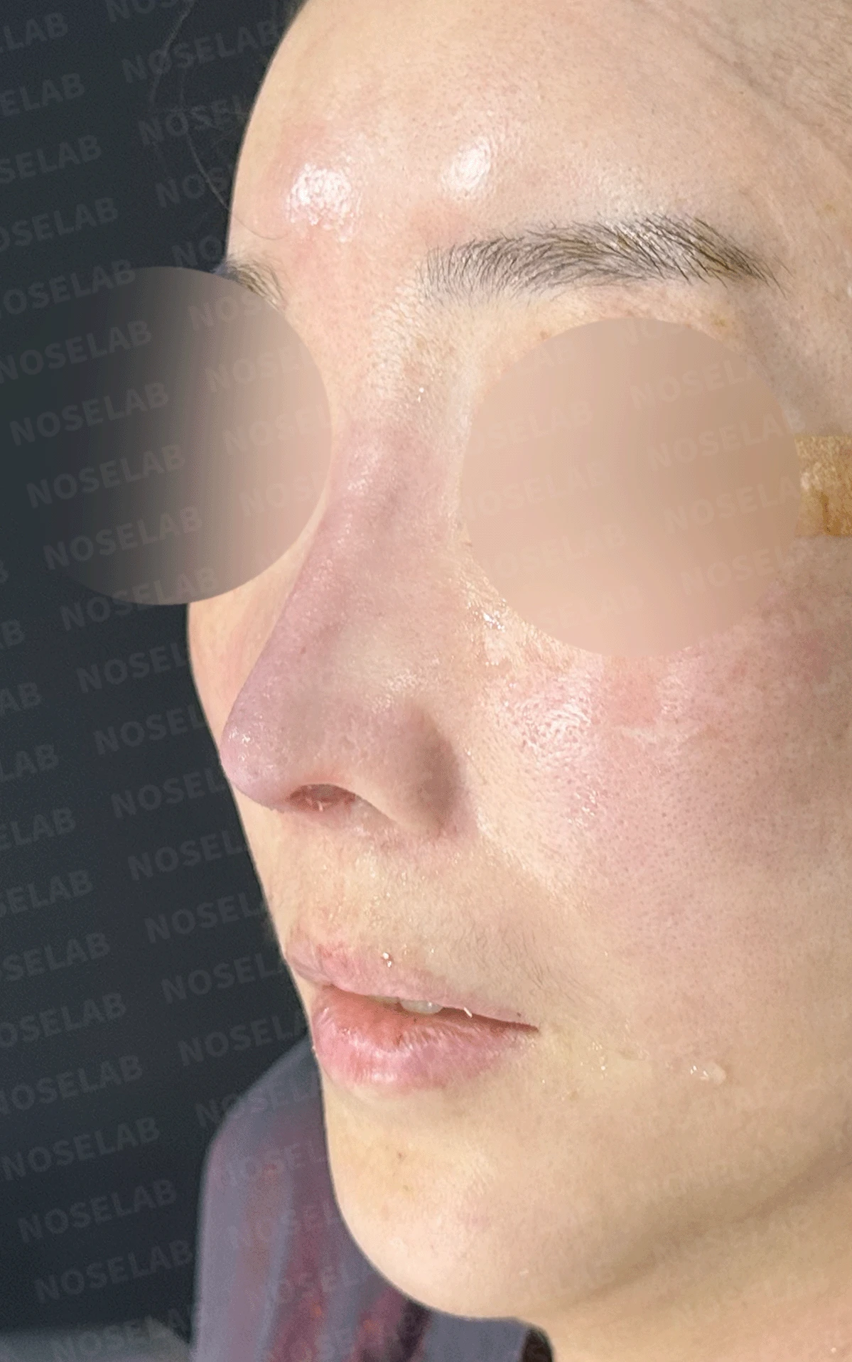 반복된 코재수술 뒤 안장코와 비밸브 협착이 생기는 이유, 전체 재건은 어떻게 하나 — 본문 사진 10