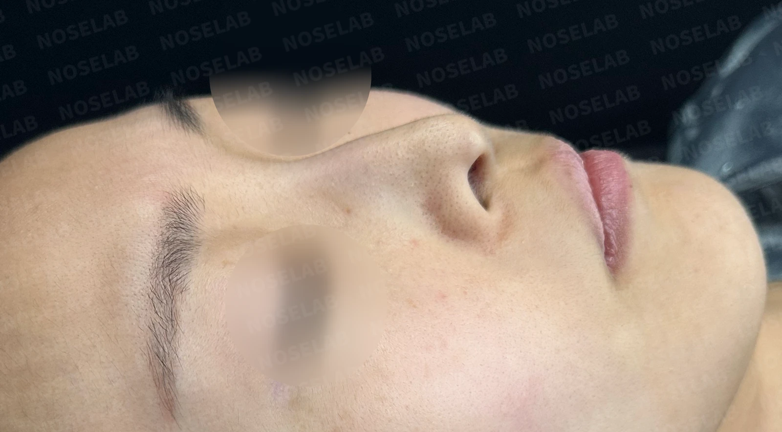 피부가 얇고 작은 들창코의 비대칭과 기능 교정 방법 — 수술 전 / 수술 직후 0일 직후 사진은 부기가 있는 상태로 최종 결과와 다를 수 있습니다.