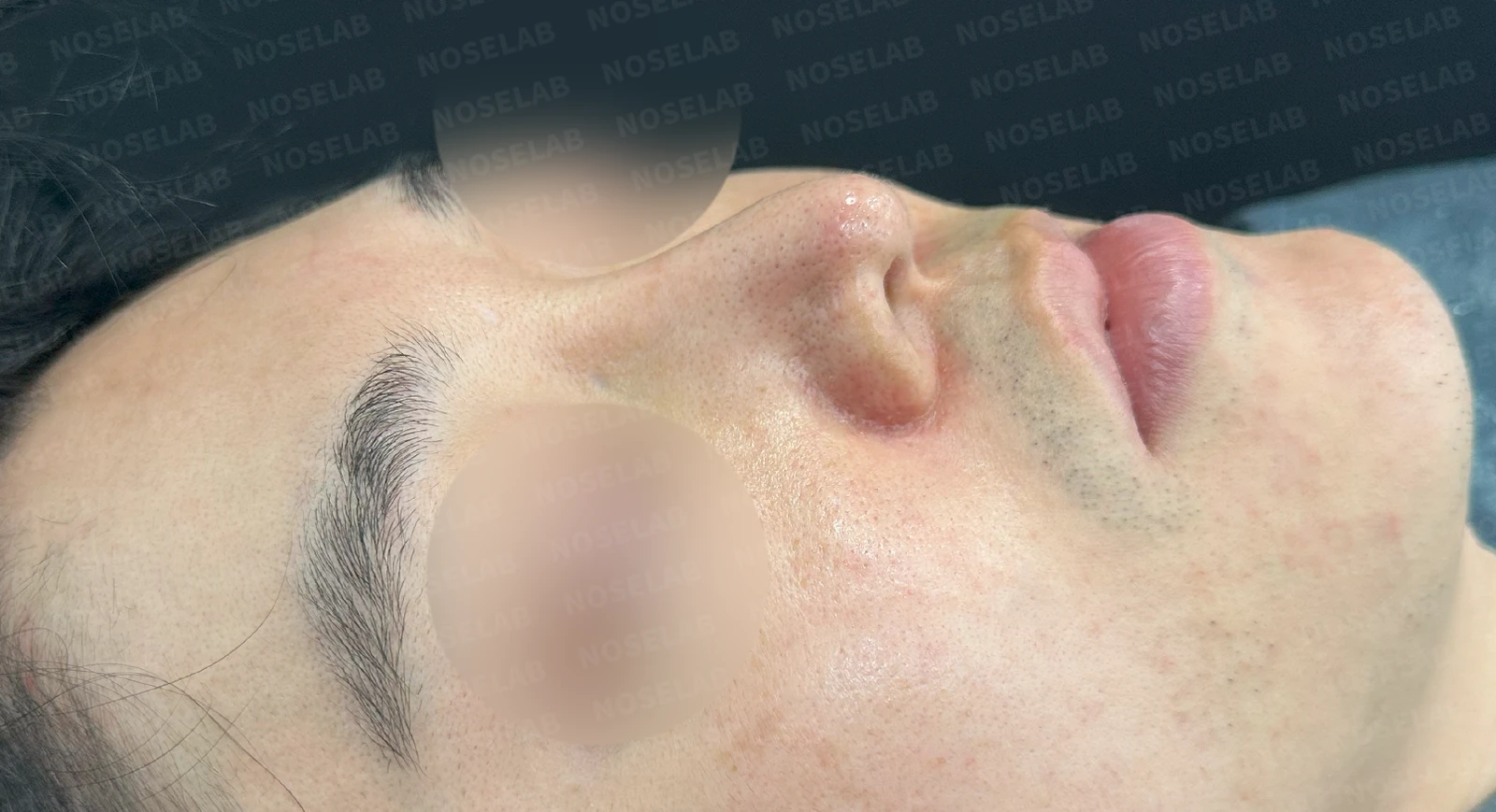 비중격연골 손상으로 무너진 코 수술 방법 — 본문 사진 7