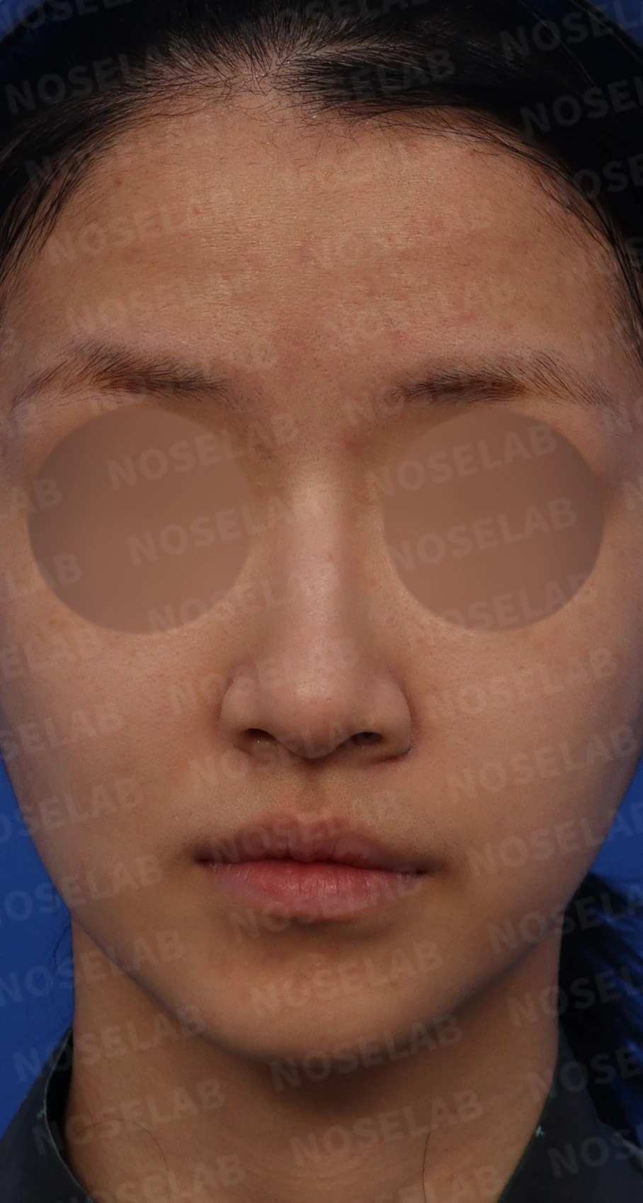 긴 코와 매부리코의 비개방 교정 방법 — 수술전 디자인 정면, 좌측 비스듬한 측면, 측면 사진입니다.