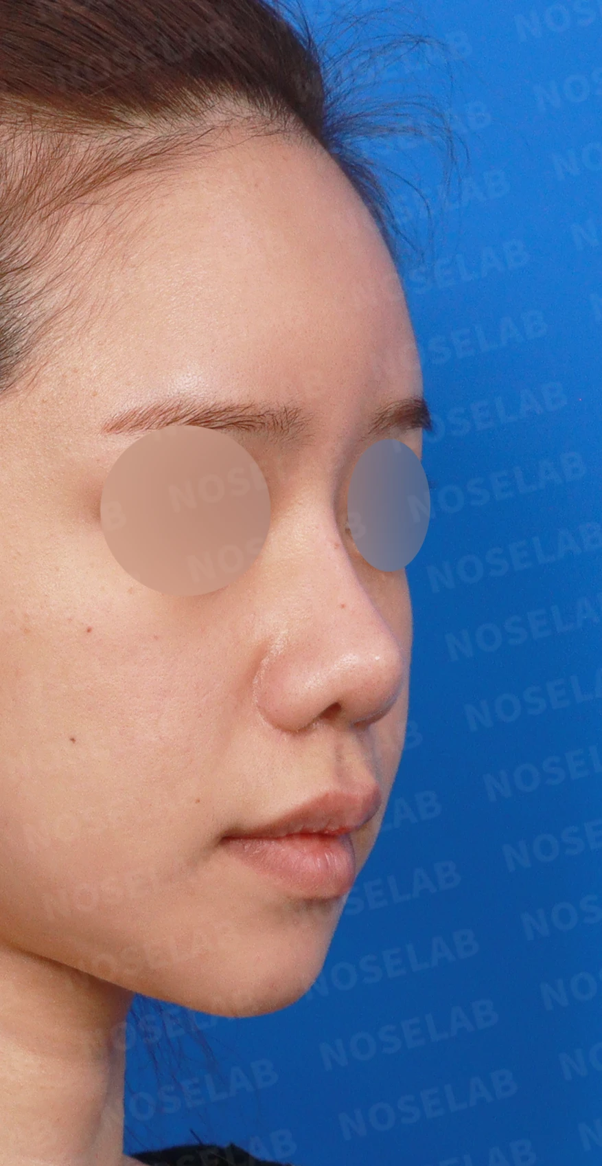 여러 차례 수술 뒤에도 코막힘과 휜 코가 남는 이유 — 디자인 상담 우측 측면, 비스듬한 측면, 비공 사진입니다.