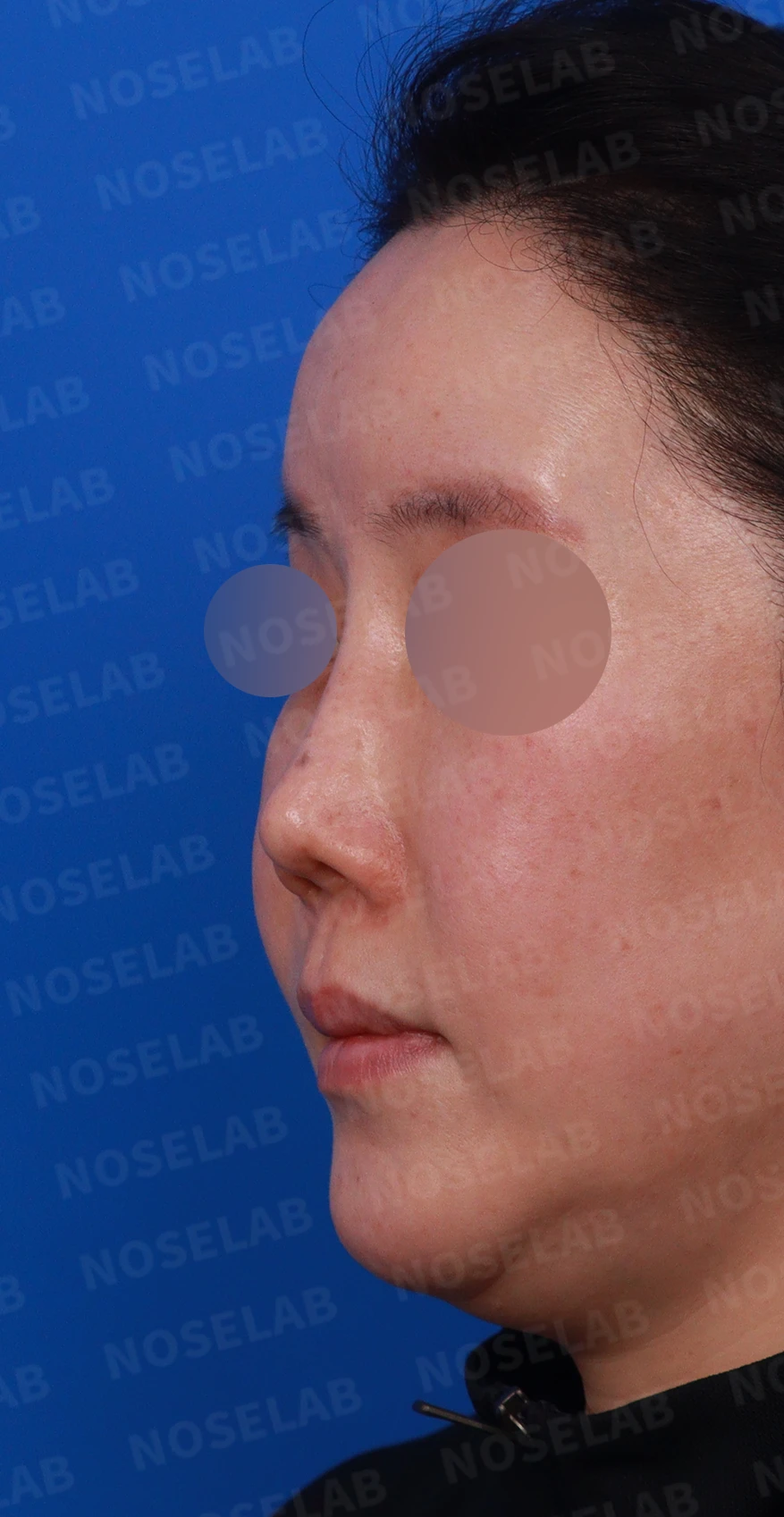 귀족수술 보형물이 코 안으로 밀려 나와 숨이 막히는 이유와 재건 방법 — 디자인 상담 정면, 좌측 , 비스듬한 측면 , 측면 사진입니다.