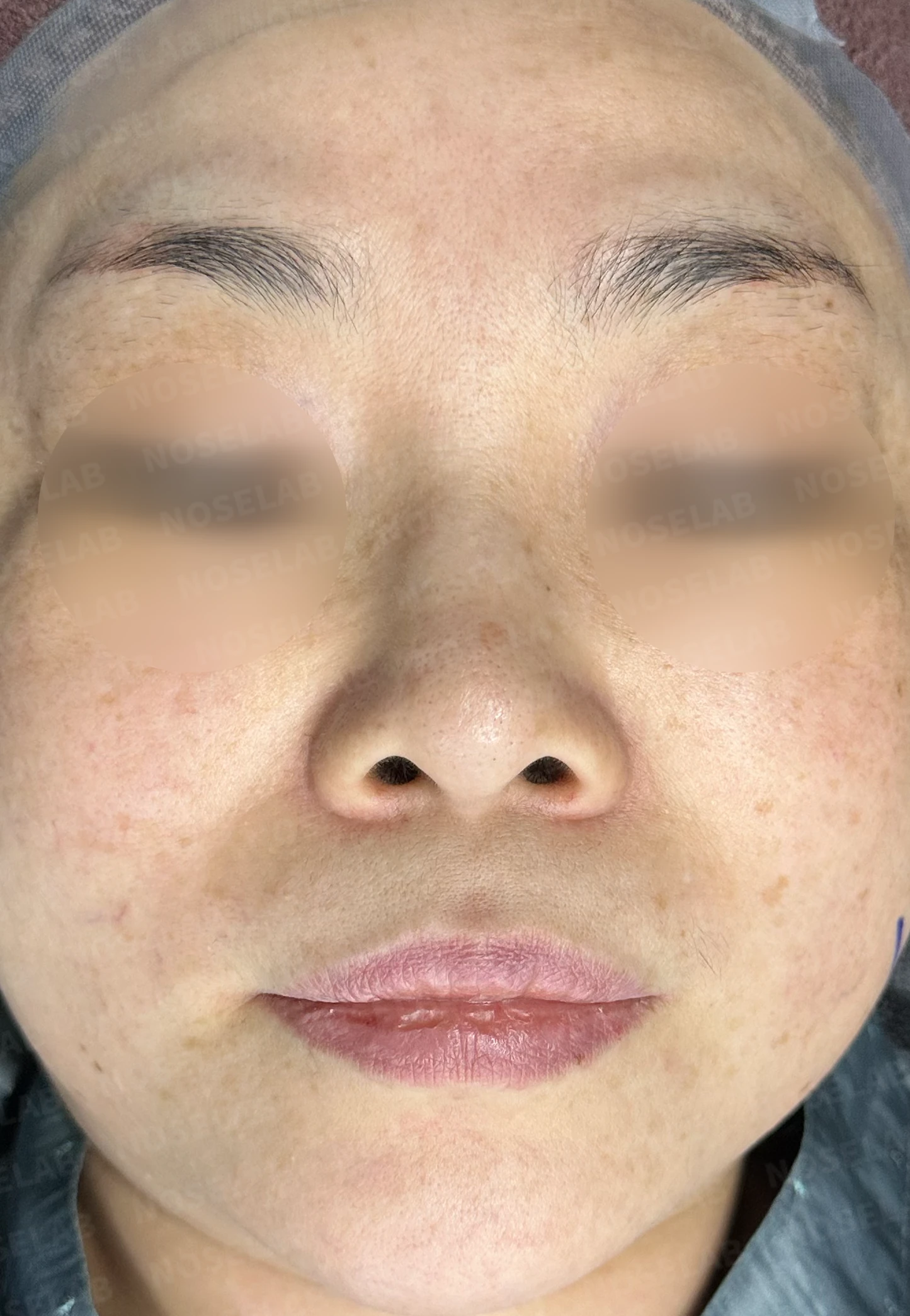 작고 들린 코에서 필러 제거와 교정을 계획하는 방법 — 수술 전 / 수술 직후 0일 직후 사진은 부기가 있는 상태로 최종 결과와 다를 수 있습니다.