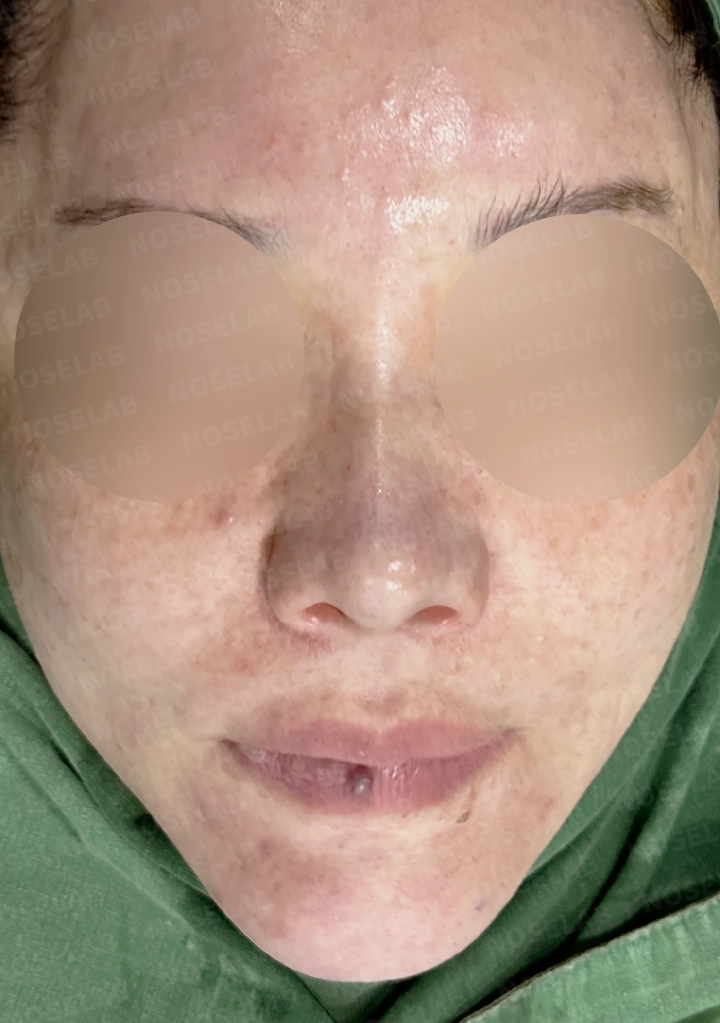 뭉툭하고 길게 처진 코가 중안면부를 길어 보이게 하는 이유, 석회화된 늑연골 재건 방법 — 수술 직후 0일 정면, 비스듬한 측면, 측면 사진입니다. 직후 사진은 부기가 있는 상태로 최종 결과와 다를 수 있습니다.