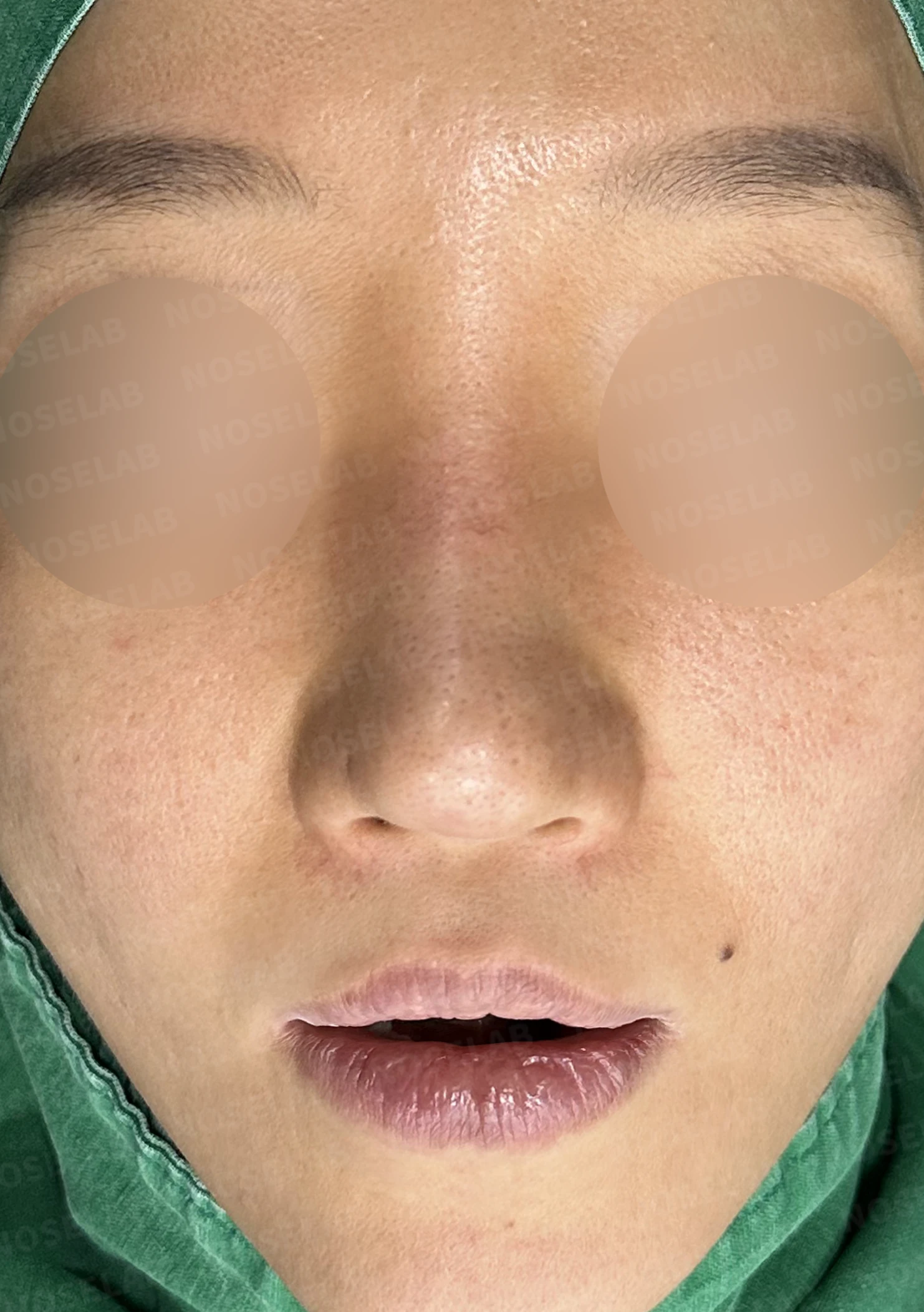여러 번의 코재수술 뒤 비중격이 무너지는 이유, 자가늑연골 전면 재건은 어떻게 하나 — 수술 전 / 수술 직후 0일 직후 사진은 부기가 있는 상태로 최종 결과와 다를 수 있습니다.