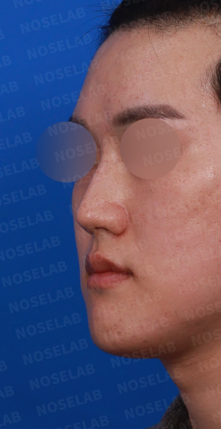 보형물 없이 코끝과 경계 부분만 교정하는 방법 — 디자인 상담 정면, 좌측 측면, 비스듬한 측면 사진