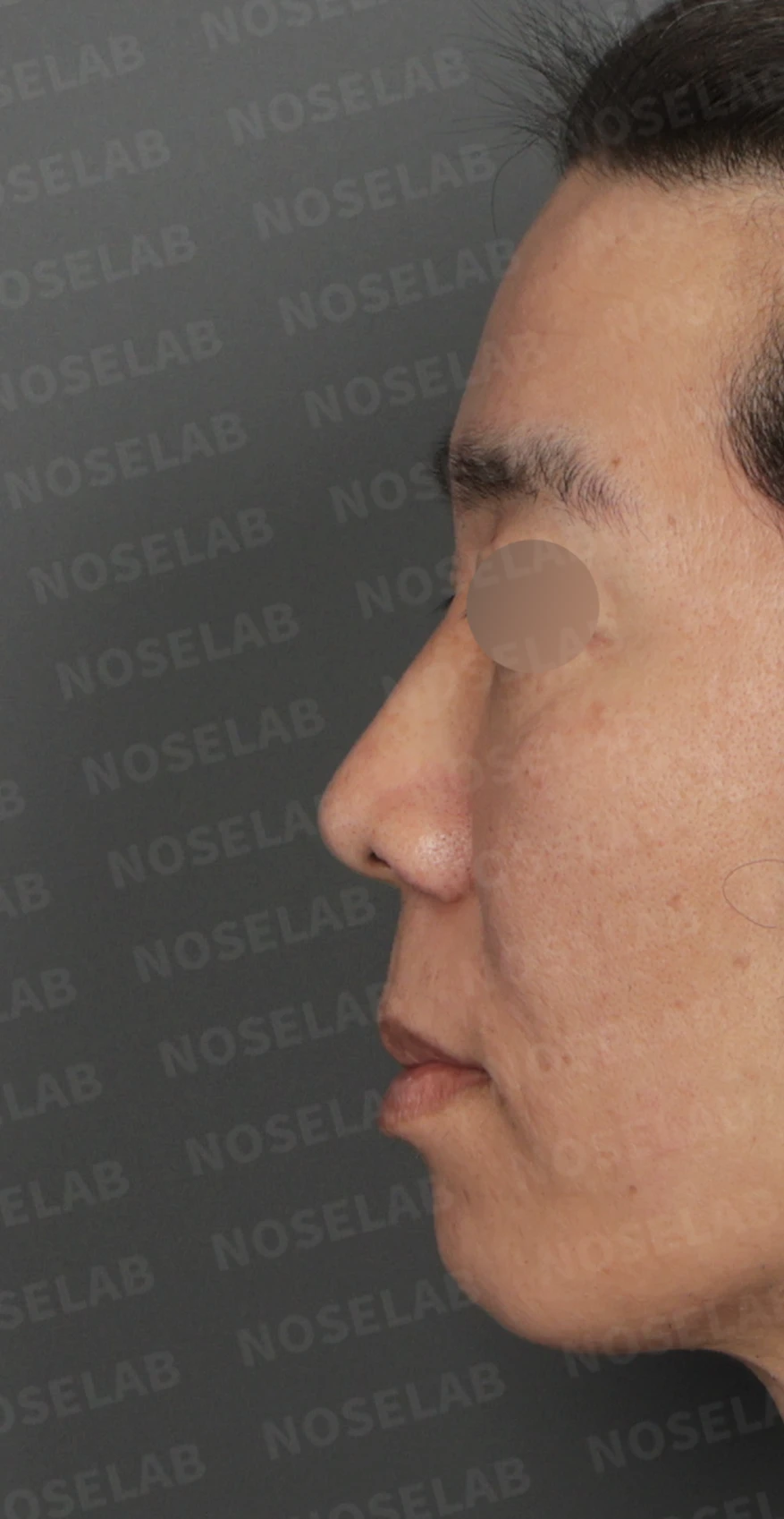 짧고 들린 코와 긴 인중, 자가늑연골로 완성한 남성스러운 직선코 — 디자인 상담 정면, 좌측 측면, 비스듬한 측면
