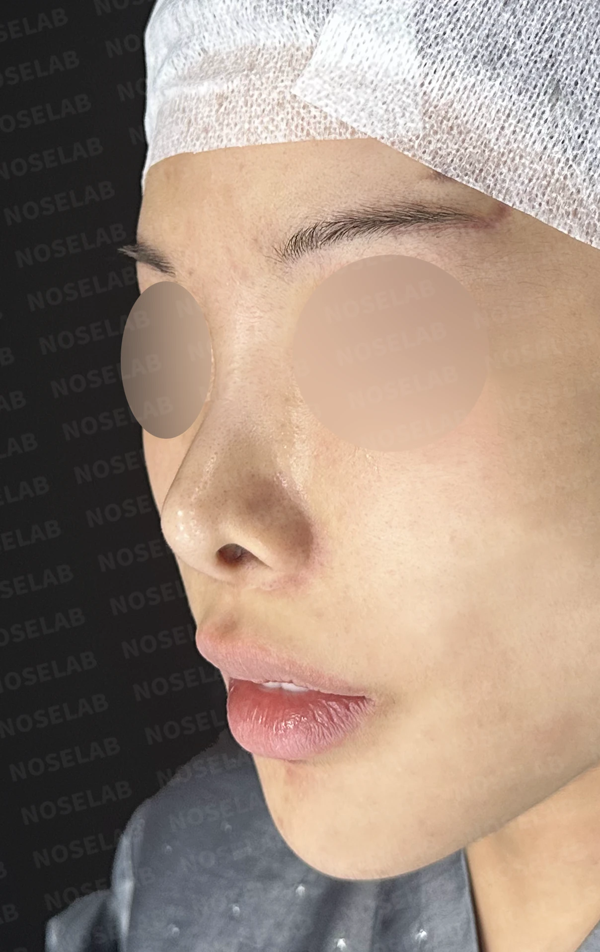 콧대 반영구 필러가 남기는 변화와 제거 후 비중격 재건 — 수술 전 / 수술 직후 0일 직후 사진은 부기가 있는 상태로 최종 결과와 다를 수 있습니다.