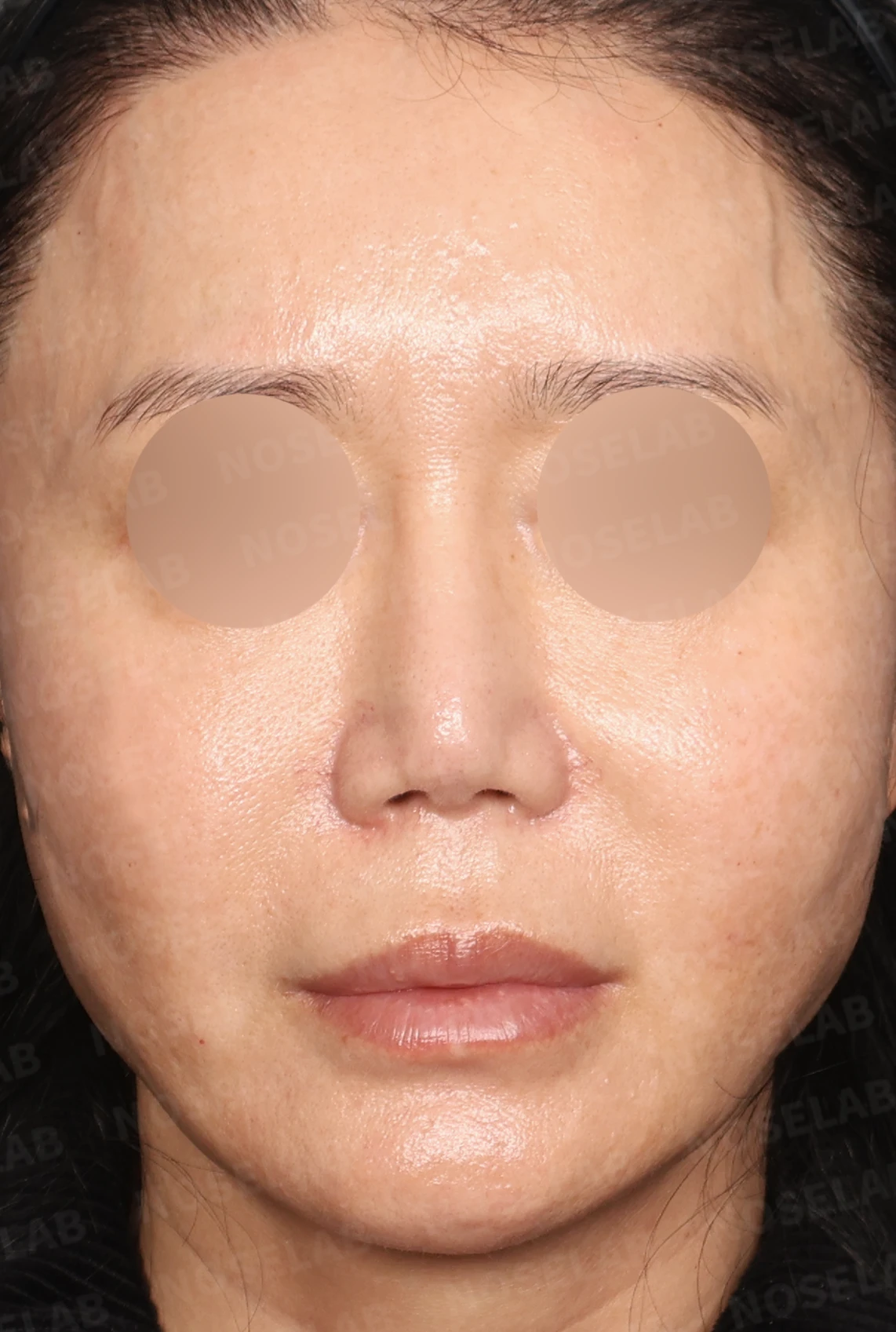 실리콘 재수술, 자가늑연골로 안전하게 코 라인 교정한 사례 — 디자인 상담 정면, 좌측 측면, 비스듬한 측면 사진입니다.
