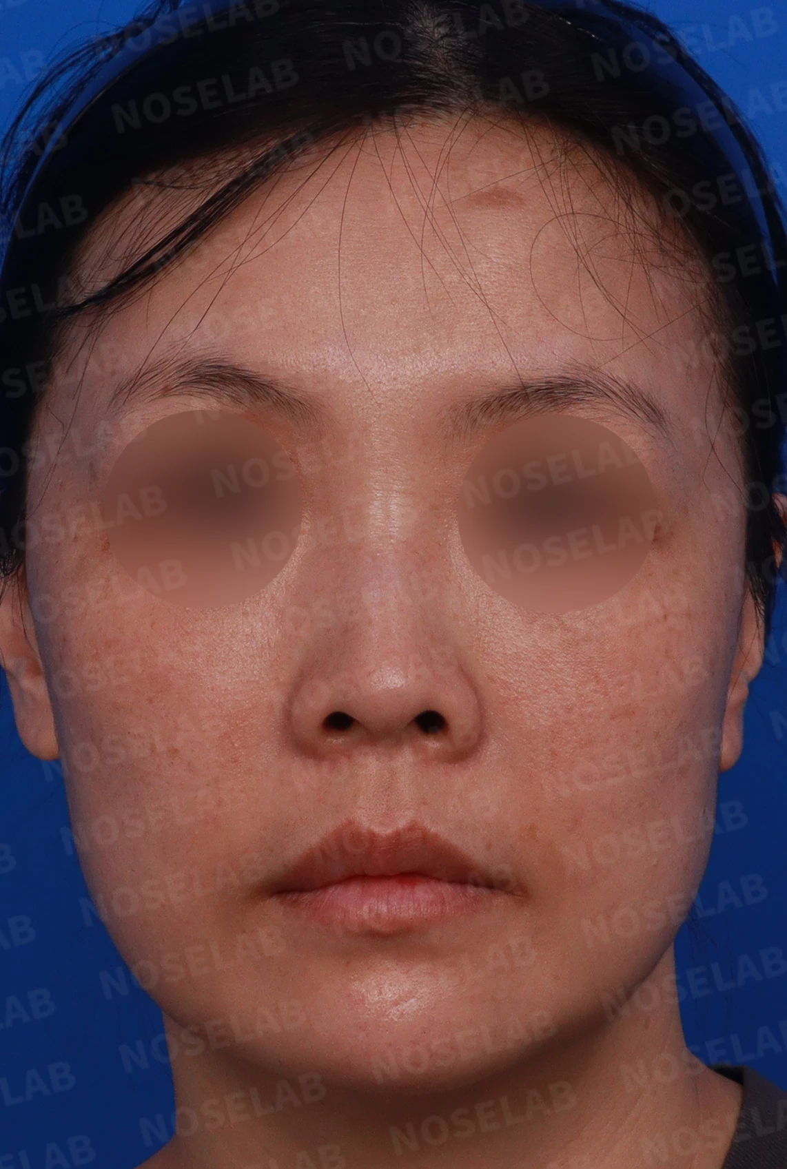 첫 코성형에서 코끝 구조와 콧구멍 노출은 어떻게 다루나 — 디자인 상담 정면 , 좌측 비스듬한 측면 , 측면 사진입니다.