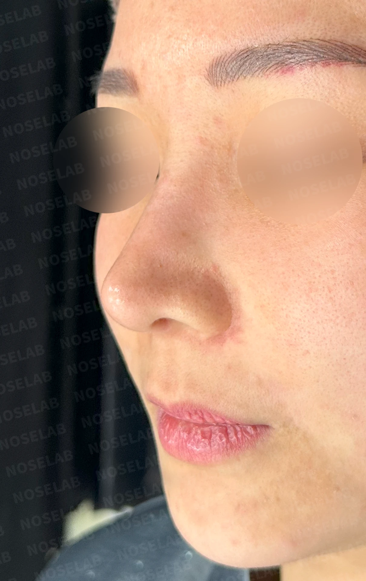 코가 휘어 보이고 비주가 한쪽으로 기우는 이유, 교정은 어떻게 하나 — 수술 전 / 수술 직후 0일 직후 사진은 부기가 있는 상태로 최종 결과와 다를 수 있습니다.