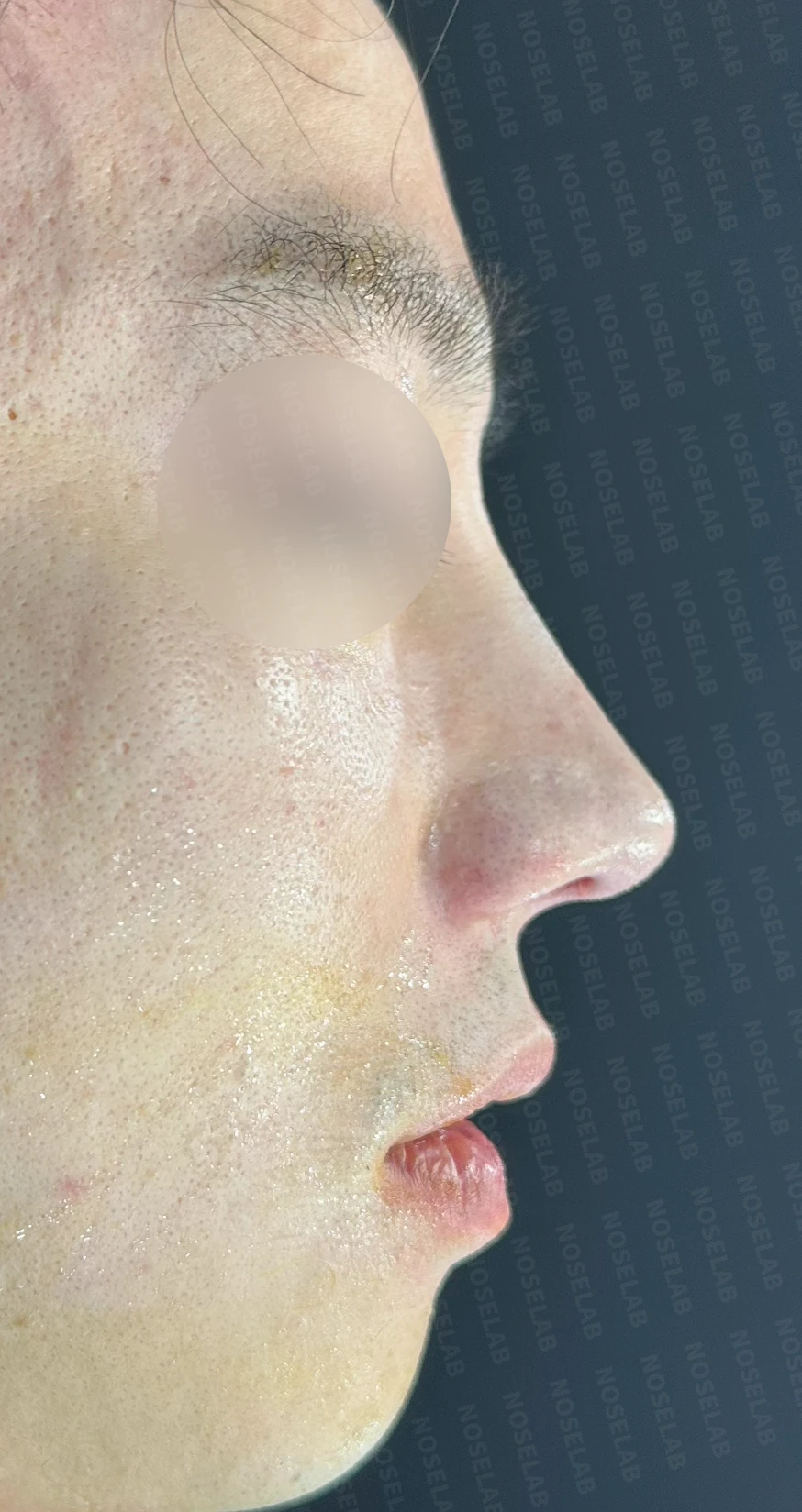 복코와 퍼진 코의 코성형 방법 — 수술 직후 0일 정면, 측면, 비스듬한 측면 사진입니다. 직후 사진은 부기가 있는 상태로 최종 결과와 다를 수 있습니다.