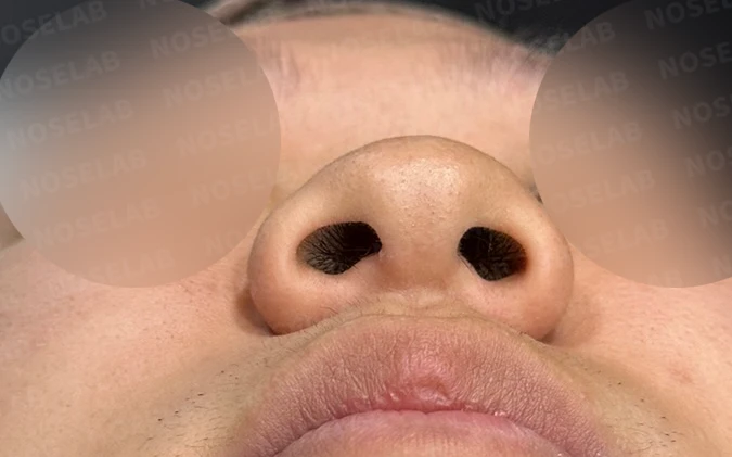 코막힘과 복코를 함께 살펴보는 교정 방법 — 수술 전 / 수술 직후 0일 직후 사진은 부기가 있는 상태로 최종 결과와 다를 수 있습니다.