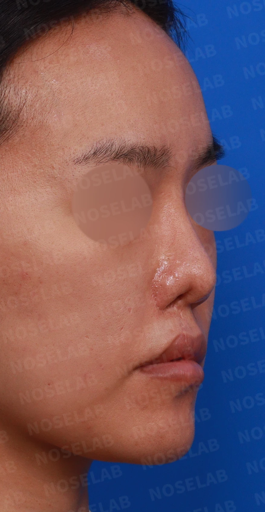 구순구개열에 동반된 코 변형의 교정 방법 — 디자인 상담 사진입니다. 비공, 우측 비스듬한 측면, 측면