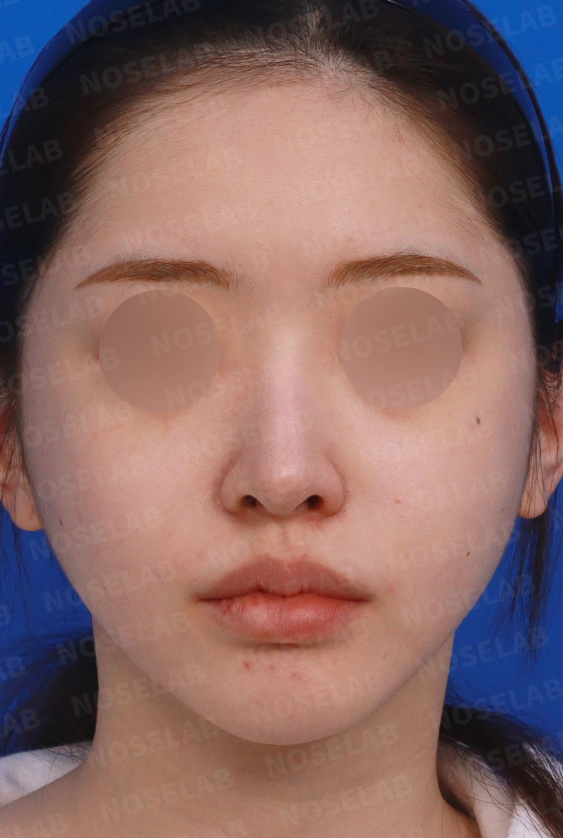 비중격이 심하게 휘고 손상되는 이유, 늑연골 재건은 어떻게 하나 — 디자인 상담 정면, 좌측 측면, 비스듬한 측면 사진입니다.