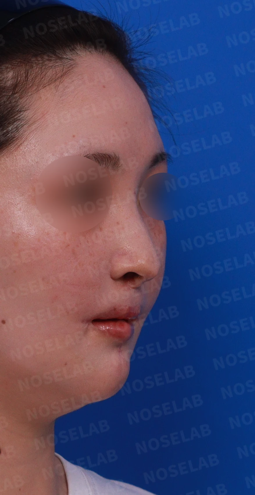 구순구개열에서 코 비대칭이 남는 이유와 늑연골·귀연골 재건 방법 — 디자인 상담 우측 측면 , 비스듬한 측면 , 비공 사진입니다.
