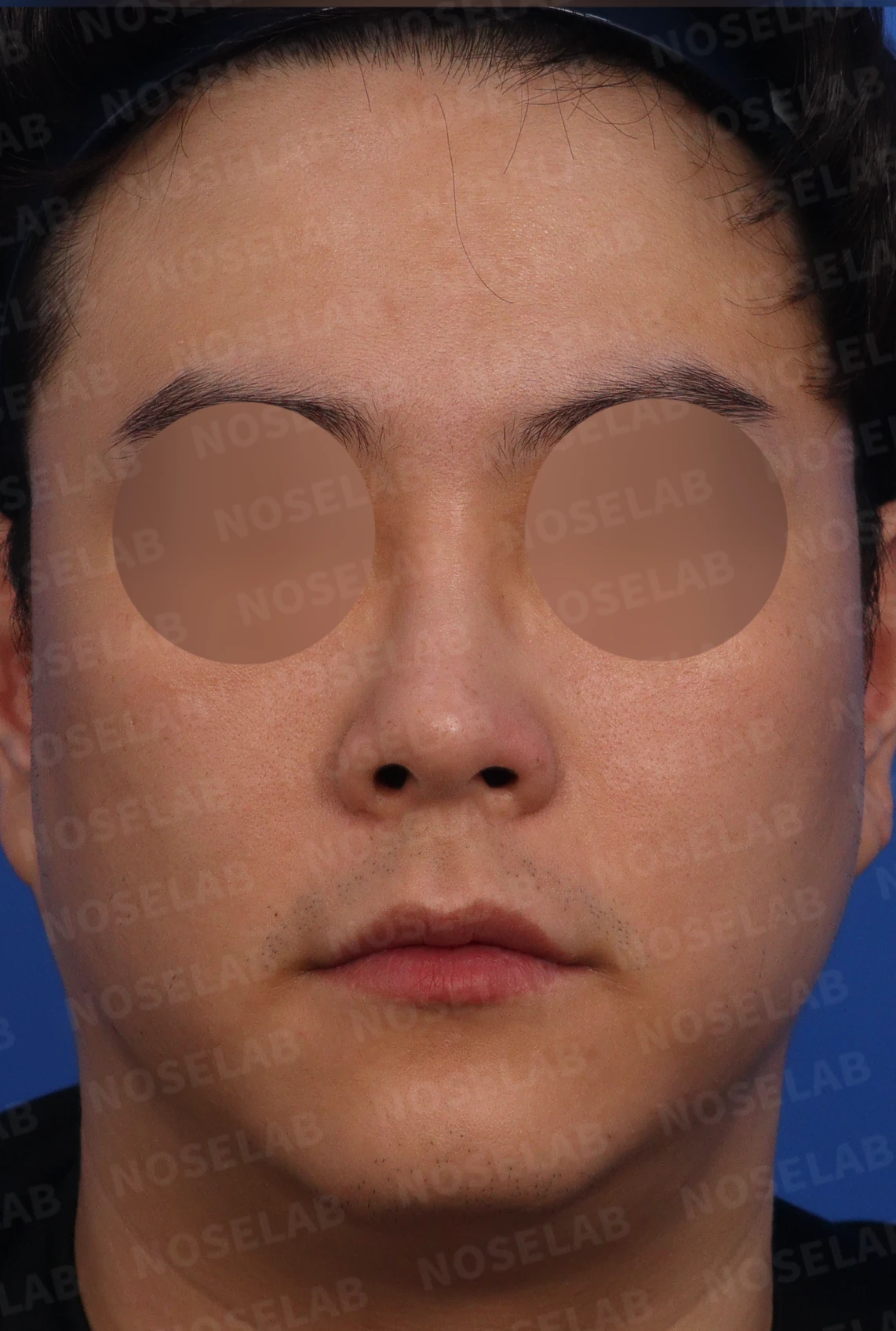 들린 곡선형 코의 형태와 교정 방법 — 수술전 디자인 상담 정면, 우측 비스듬한 측면, 측면 사진입니다.