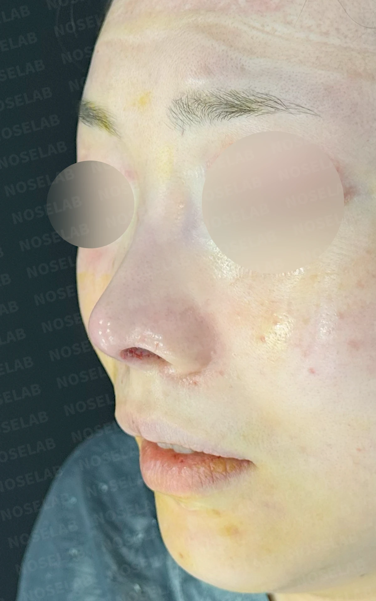 비중격 연골을 과도하게 채취하면 생기는 문제와 재건 방법 — 수술 직후 0일 정면, 비스듬한 측면, 측면 사진 직후 사진은 부기가 있는 상태로 최종 결과와 다를 수 있습니다.