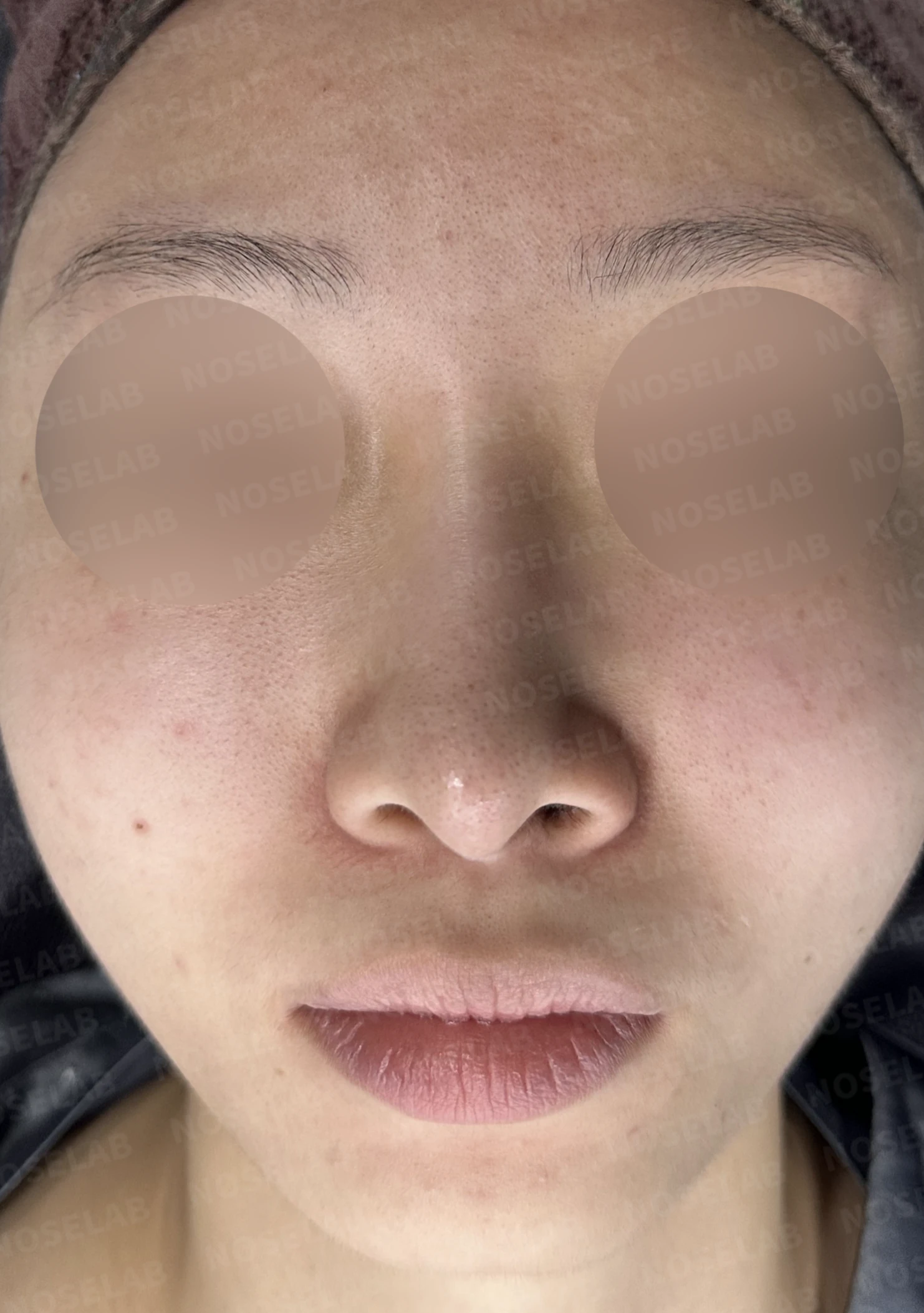 길고 처진 코, 휜코 교정과 코막힘까지 한 번에 해결한 재수술 사례 — 전(좌) 직후(후)