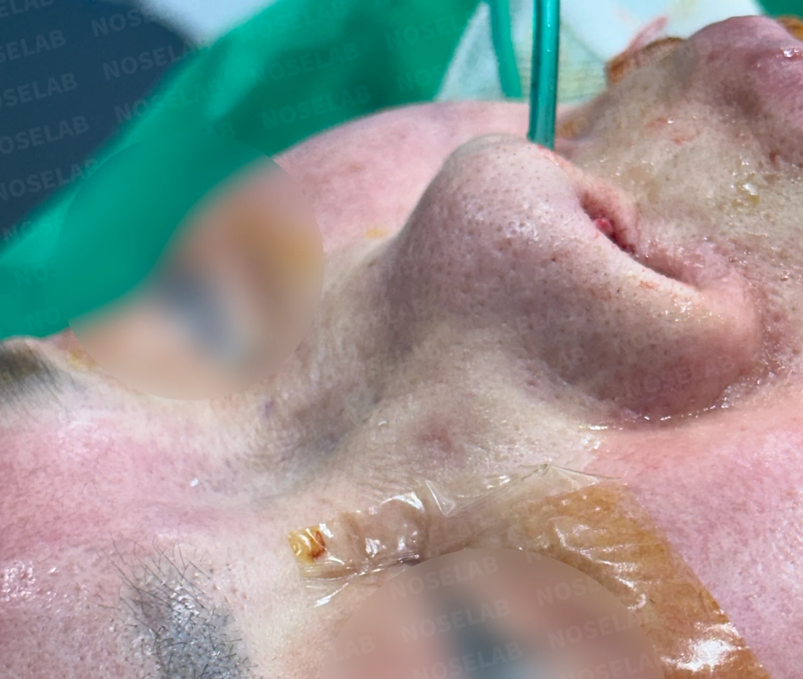 불법 주사 시술 뒤 코가 들리고 짧아지는 이유, 이물질 제거와 재건은 어떻게 하나 — 이물질 제거 후 함몰된 콧대 사진입니다.