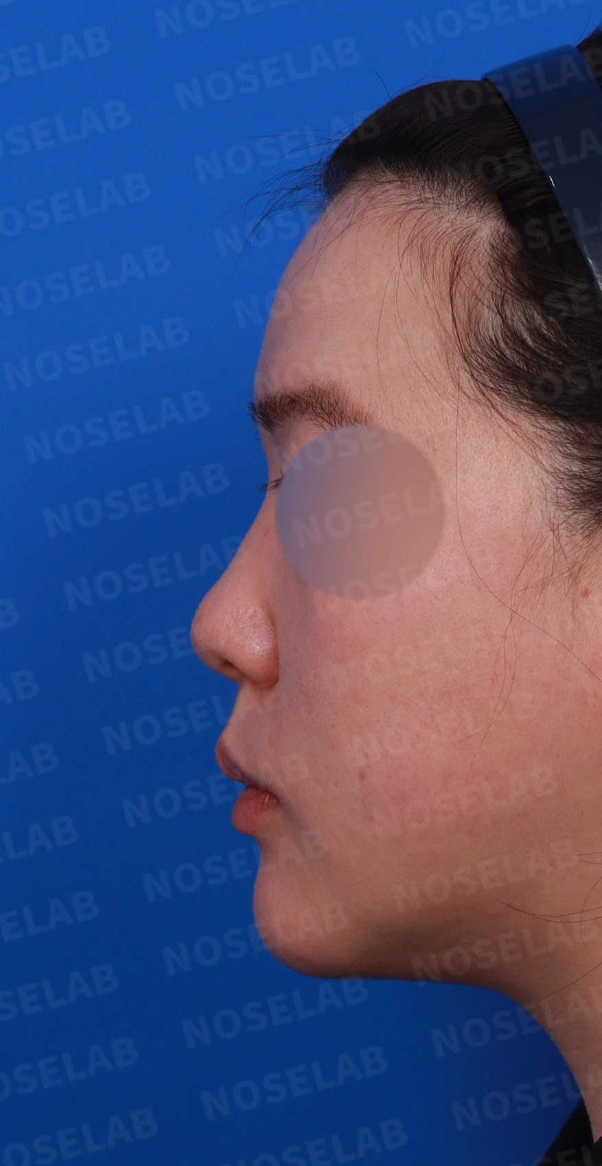 코끝이 퍼지고 입체감이 없어 보이는 이유, 복코 교정은 어떻게 하나 — 디자인 상담 정면, 좌측 측면, 비스듬한 측면 사진