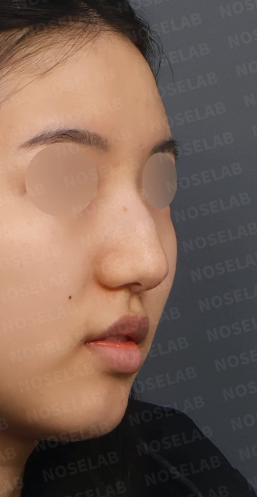 매부리코와 긴코 교정, 자가늑연골로 오똑한 코끝과 코막힘까지 해결 — 디자인 상담 우측 측면, 비스듬한 측면, 비공 사진입니다.