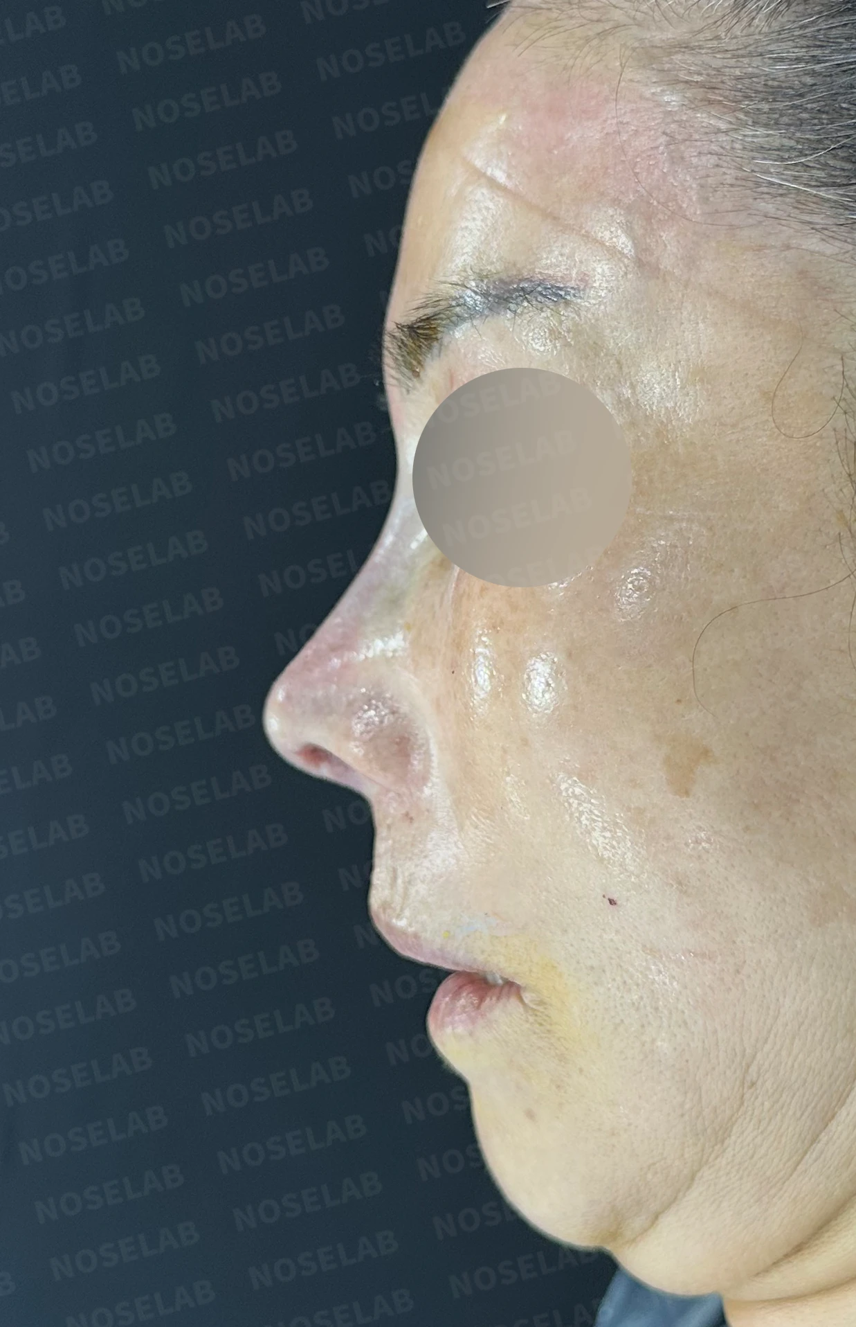 오래된 실리콘 보형물이 변형과 통증을 일으키는 이유, 늑연골 재건은 어떻게 하나 — 수술 전 / 수술 직후 0일 직후 사진은 부기가 있는 상태로 최종 결과와 다를 수 있습니다.