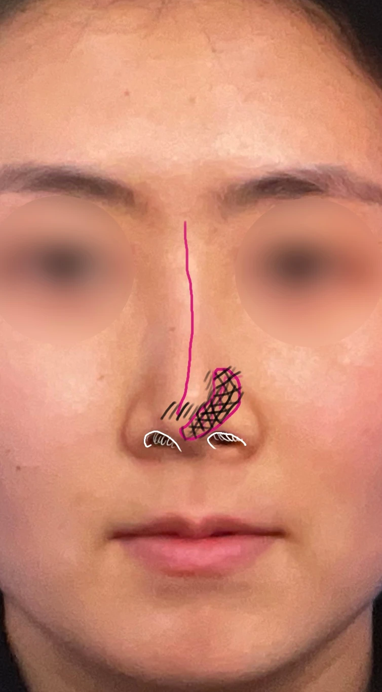 기능성 코성형·휘어진 비주 바로잡기 방법 — 수술전 디자인 정면사진