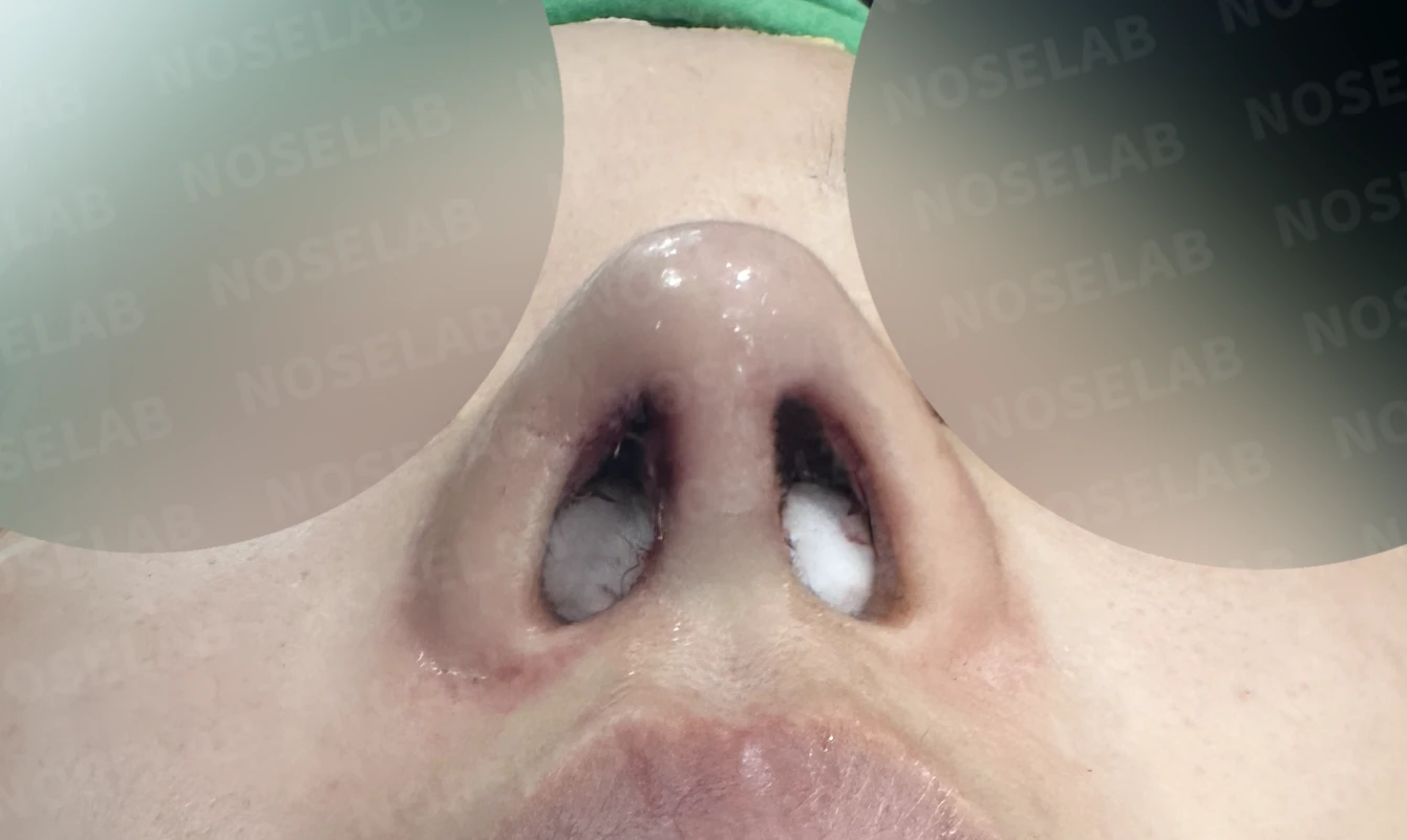 짧고 들린 코, 자가늑연골로 비중격 재건한 코재수술 사례 — 직후 비공 사진 입니다.
