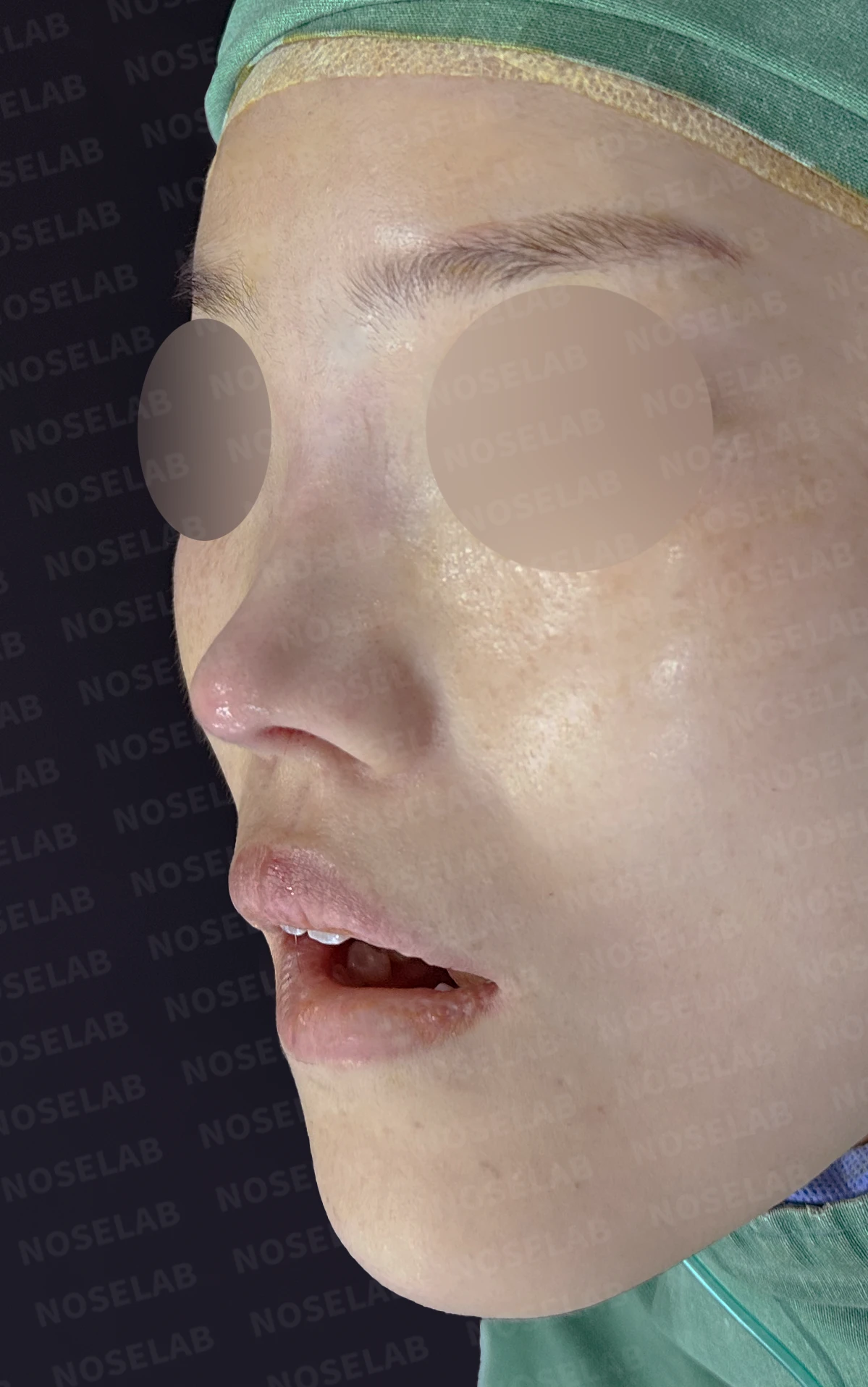 짧고 들린 코와 휜 코가 함께 생기는 이유, 비중격 연장 교정은 어떻게 하나 — 수술 전 / 수술 직후 0일 직후 사진은 부기가 있는 상태로 최종 결과와 다를 수 있습니다.