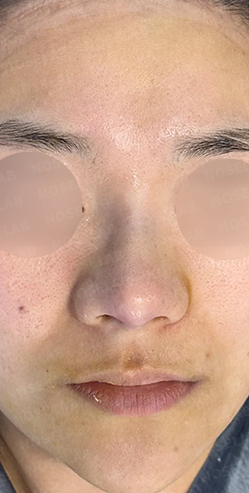 복코 수술은 어떻게 하나요? — 수술 직후 0일 사진들 90도 측면, 45도 측면, 정면 직후 사진은 부기가 있는 상태로 최종 결과와 다를 수 있습니다.