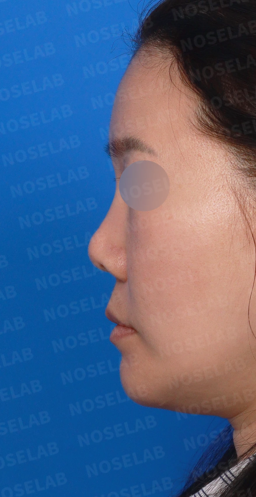 오래된 코성형 뒤 코끝이 들리고 콧구멍이 드러나는 이유, 제거와 자가진피 재건은 어떻게 하나 — 디자인 상담 정면, 좌측 측면, 비스듬한 측면 사진