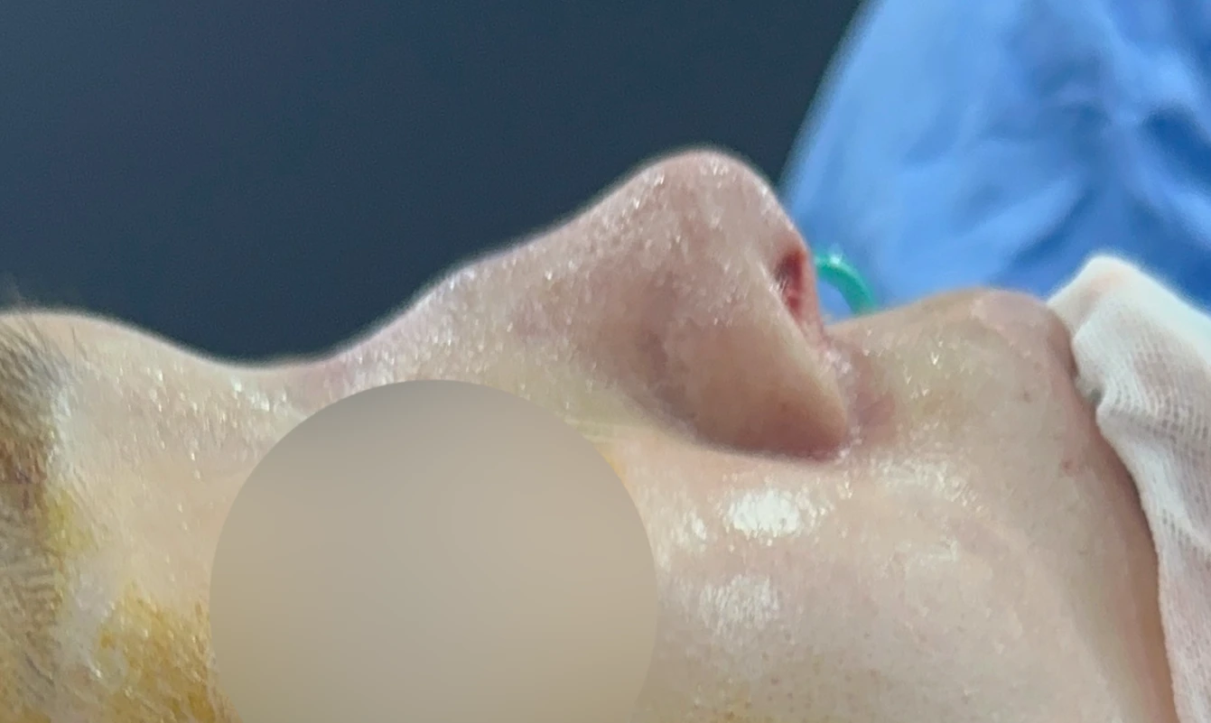영구 필러가 코 모양을 바꾸는 과정과 제거 후 재건 방법 — 본문 사진 7