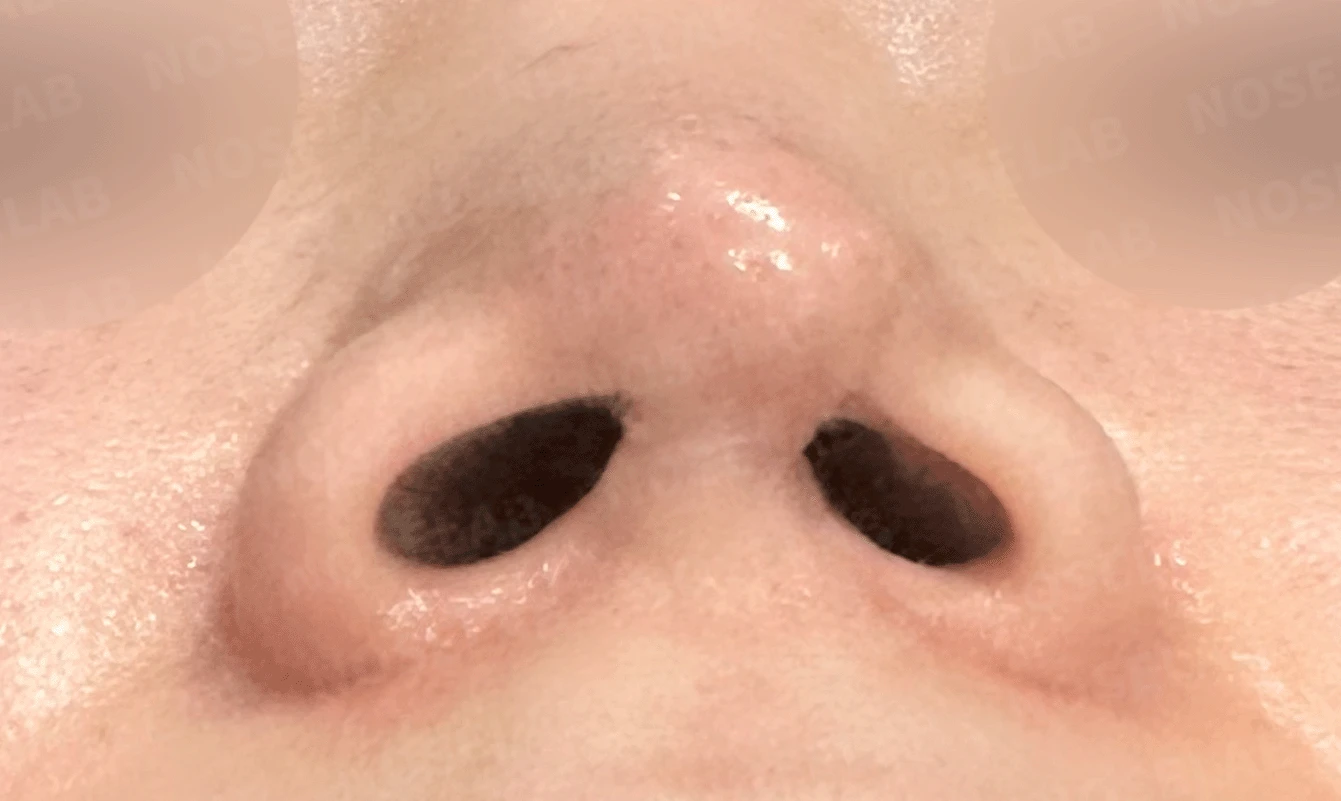 콧구멍을 막는 종괴가 생기는 이유, 제거와 재건은 어떻게 하나 — 본문 사진 21