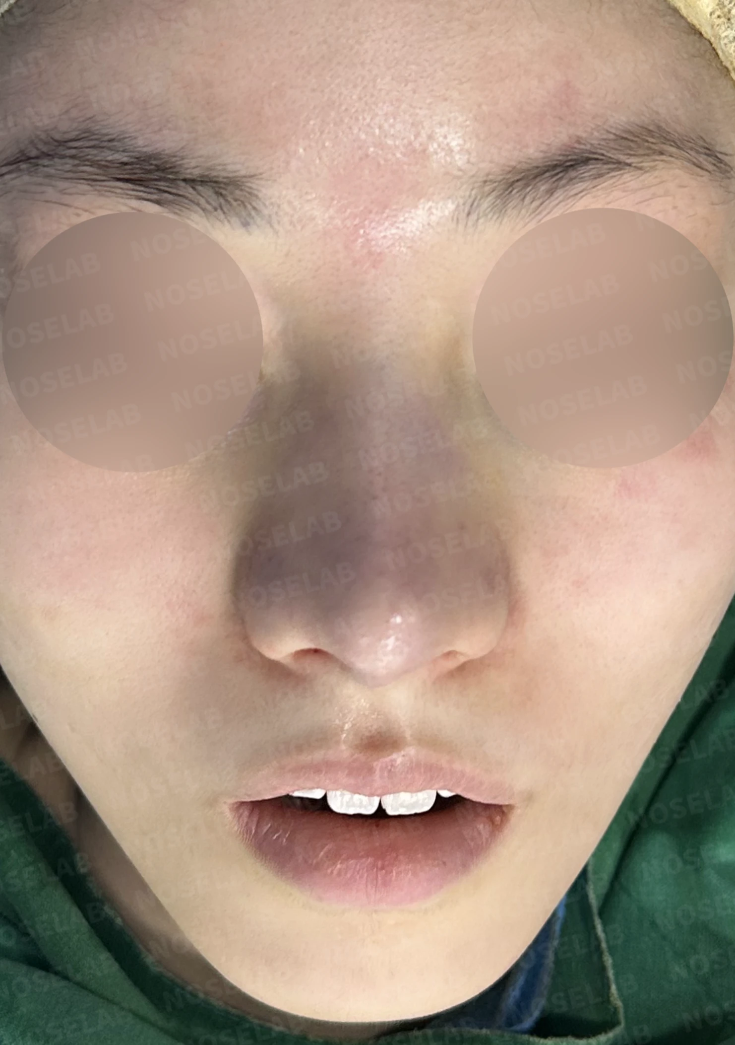복코와 주먹코, 자가늑연골로 얄쌍하고 여성스러운 코 완성 — 수술직후 정면, 비스듬한 측면, 측면 사진입니다.