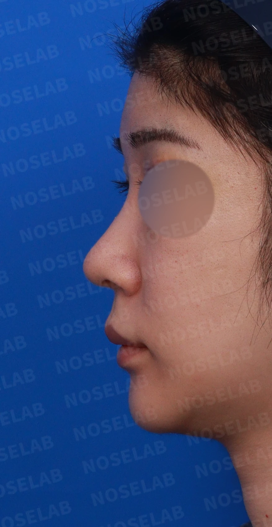 코가 뭉툭하고 퍼져 보이는 이유, 비순각과 비주는 어떻게 교정하나 — 디자인 상담 정면, 좌측 측면, 비스듬한 측면 사진
