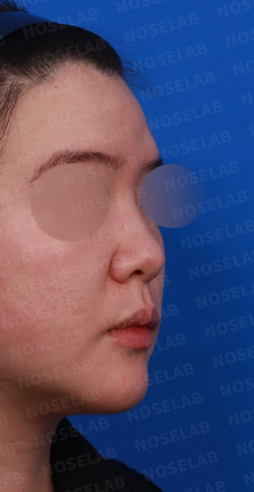 코끝이 퍼지고 입체감이 없어 보이는 이유, 복코 교정은 어떻게 하나 — 디자인 상담 우측 측면, 비스듬한 측면 사진, 비공 사진