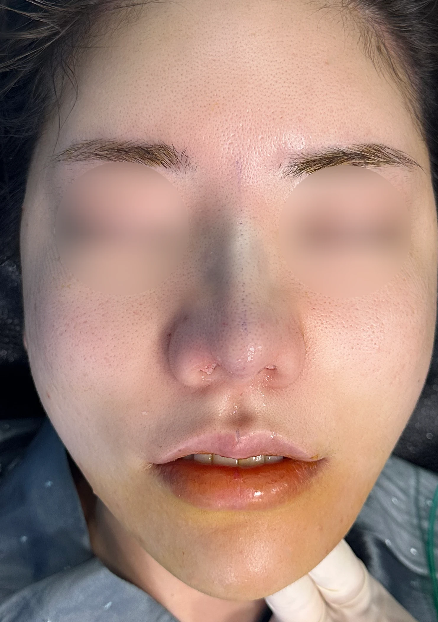 복코 교정과 비주 내리기 방법 — 수술 전 / 수술 직후 0일 직후 사진은 부기가 있는 상태로 최종 결과와 다를 수 있습니다.