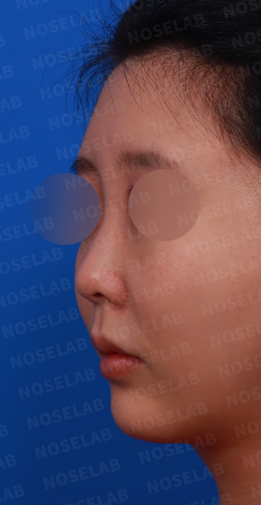 양악수술 뒤 코가 퍼지고 막히는 이유, 기능과 형태를 함께 보는 방법 — 디자인 상담 정면, 좌측 측면, 비스듬한 측면 사진입니다.